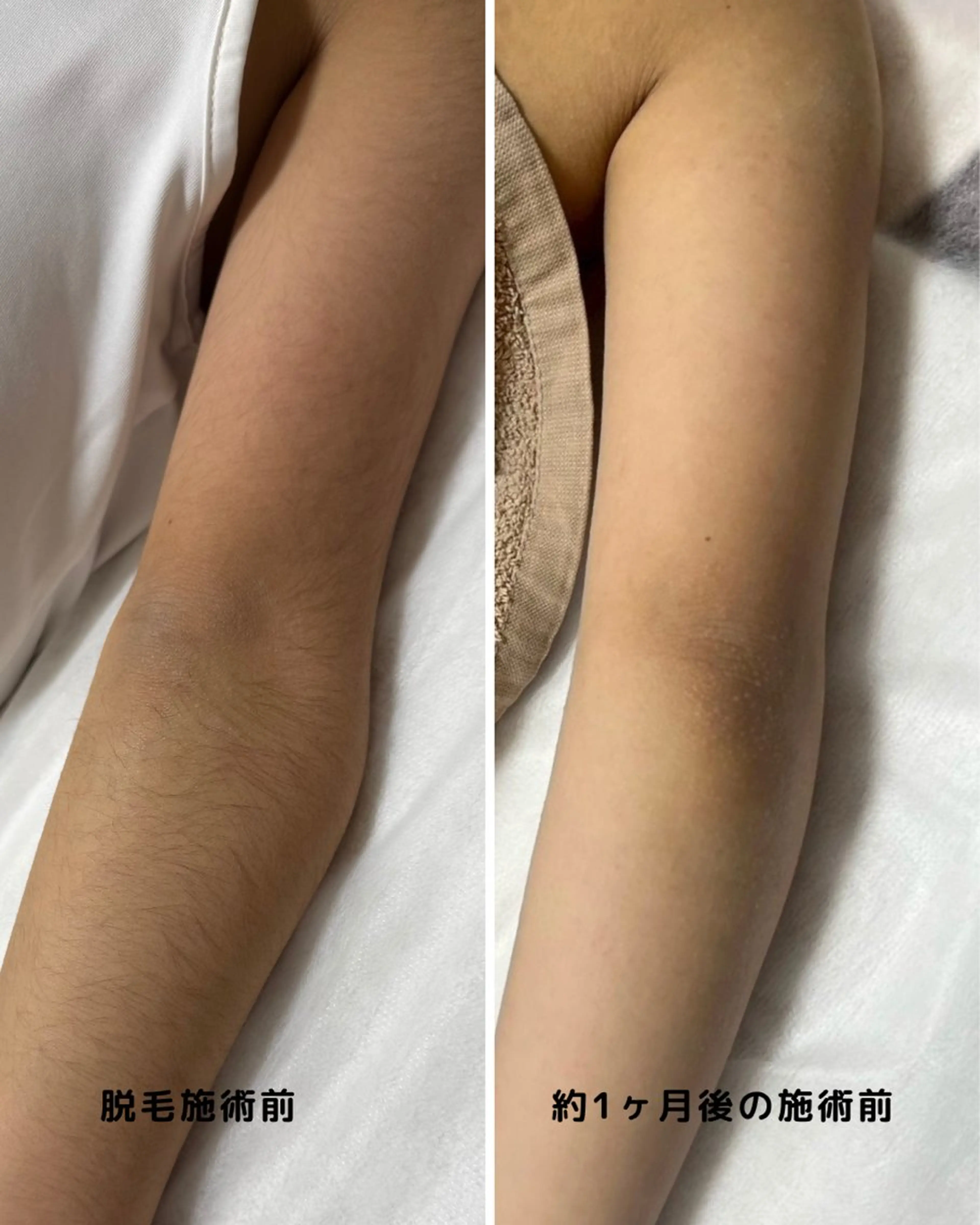 脱毛 シミ取り*韓国肌 エステサロン✶クロヌのエステ・リラクイメージ