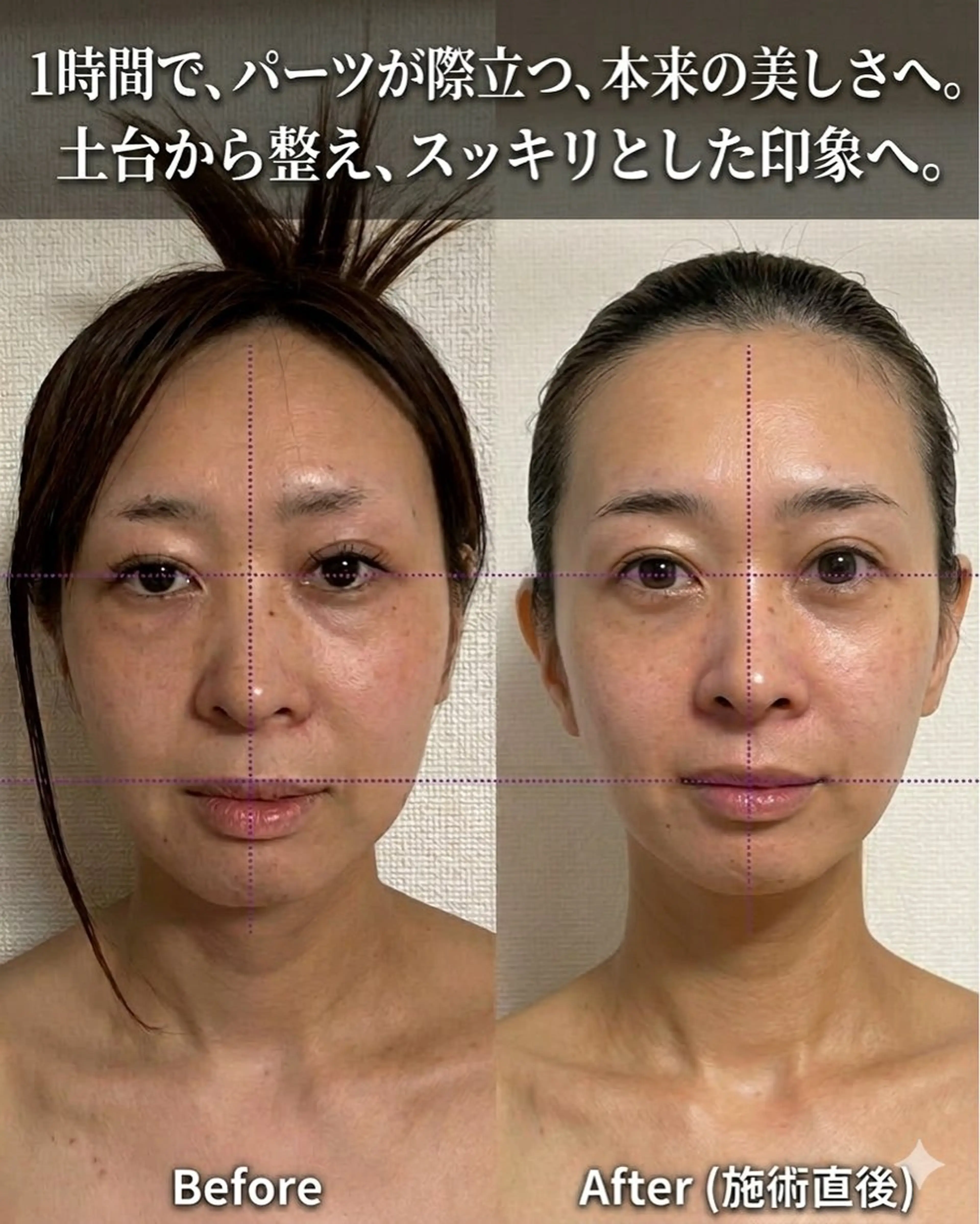 【姿勢×バストまわりケア】IW波で背中・デコルテから整える✨本格フェイシャル×デコルテトリートメント付き（大阪梅田）の写真