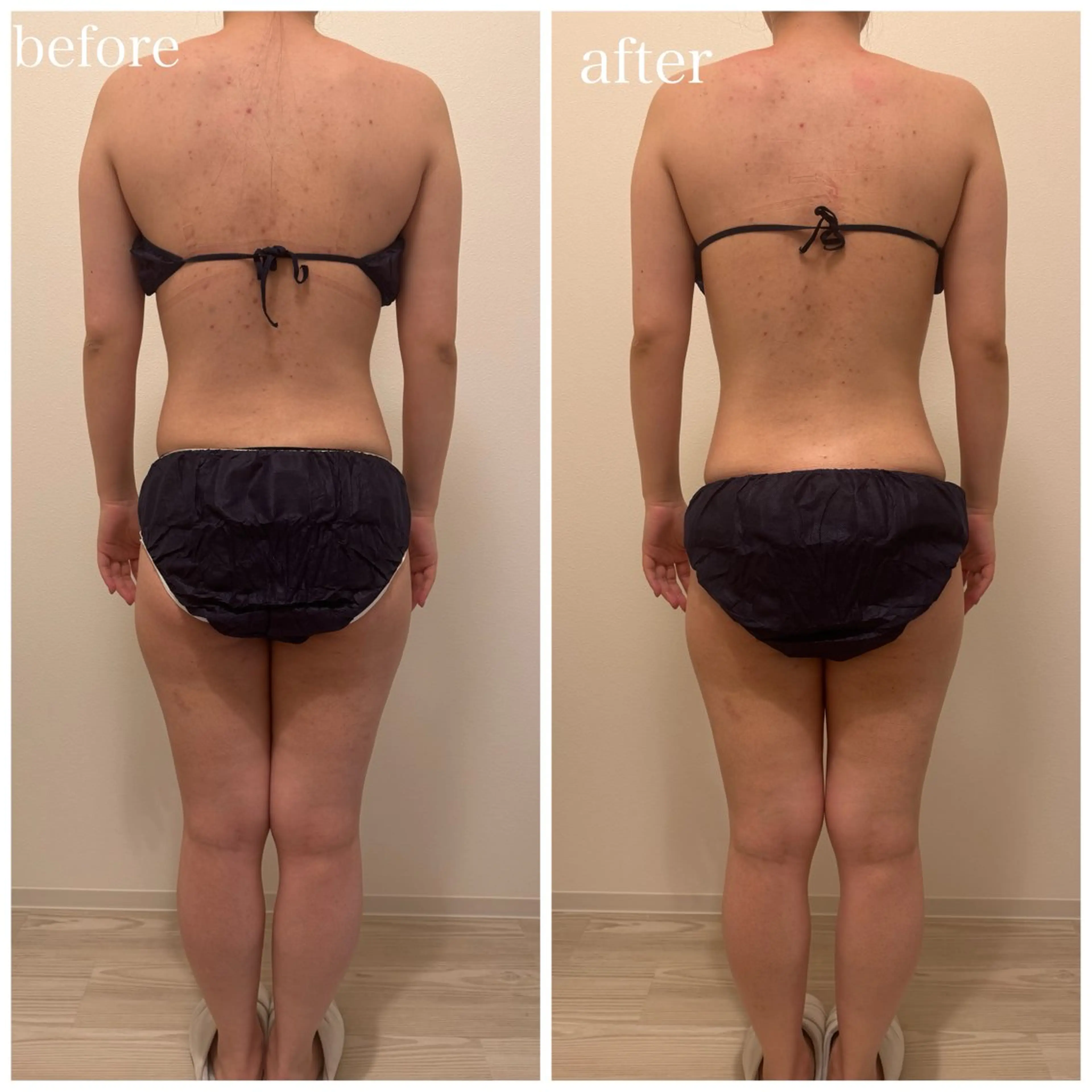 【ミニモ限定】一度で実感！ハイパーナイフ半身（下半身or上半身）20分¥2,980(モニター）の写真