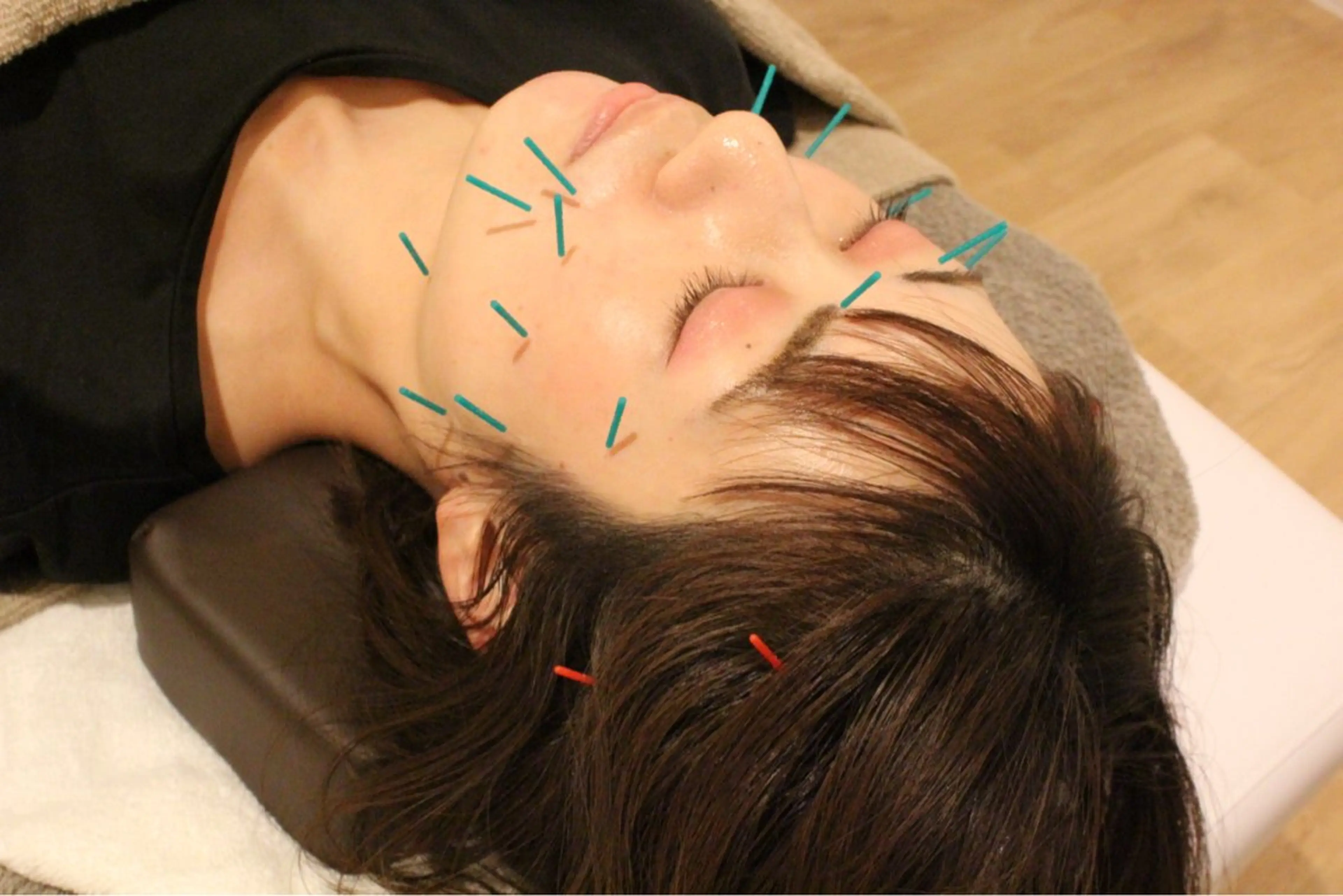 人気No.1👑【むくみすっきり💆】スタンダード美容鍼➕ドライヘッドスパ　50分の写真