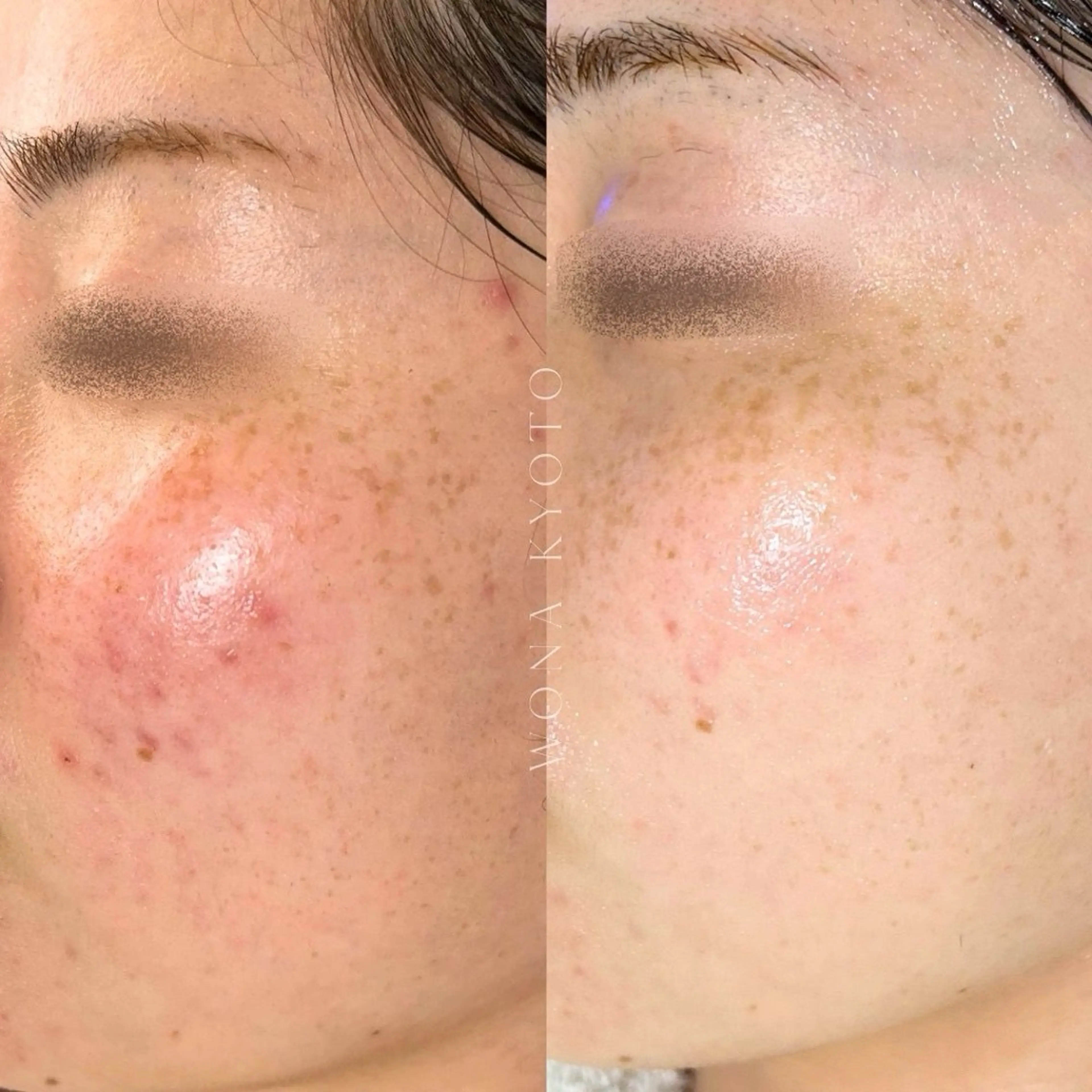 【赤み肌荒れ/再建管理】皮膚熱鎮静ゆらぎ改善！問題を繰り返さない強い肌へ◎白玉酸素セラピー+ベルドソ管理の写真