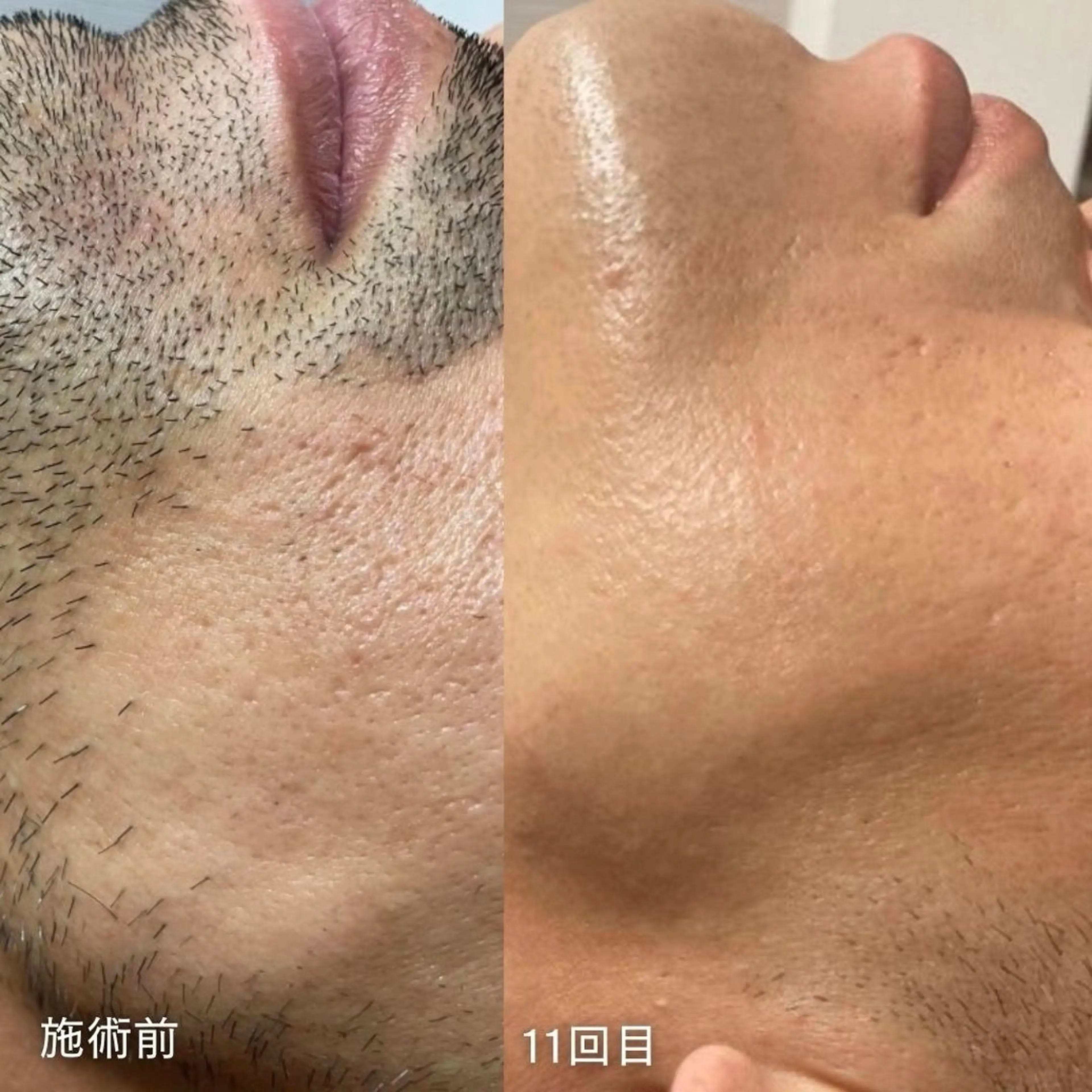 脱毛　Beauty salon Lumiere（ルミエール）所属・完全都度払い脱毛⭐︎ Lumiereのエステ・リラクイメージ