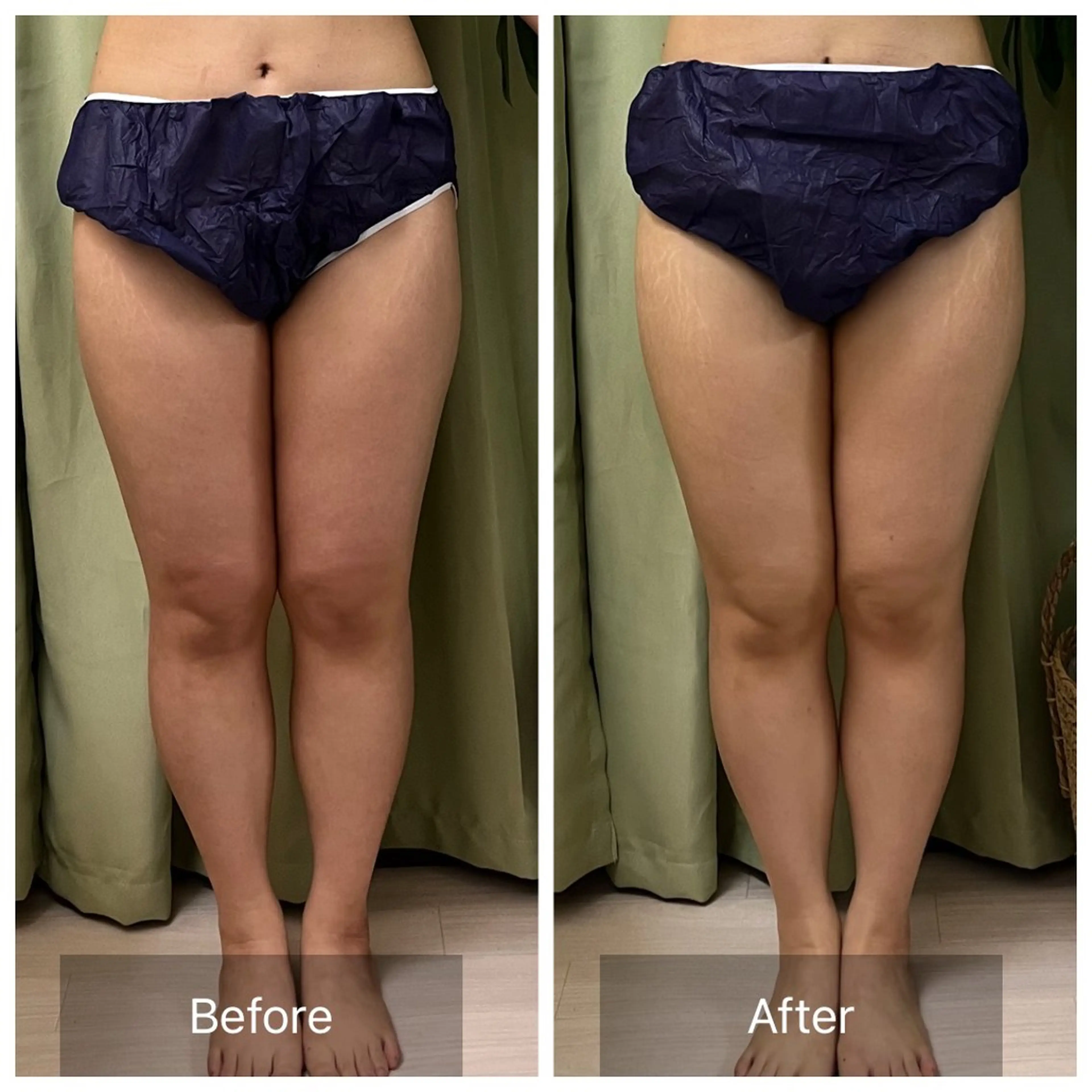 エステ リラク 【元に戻らない】 小顔&部分痩せのその他イメージ