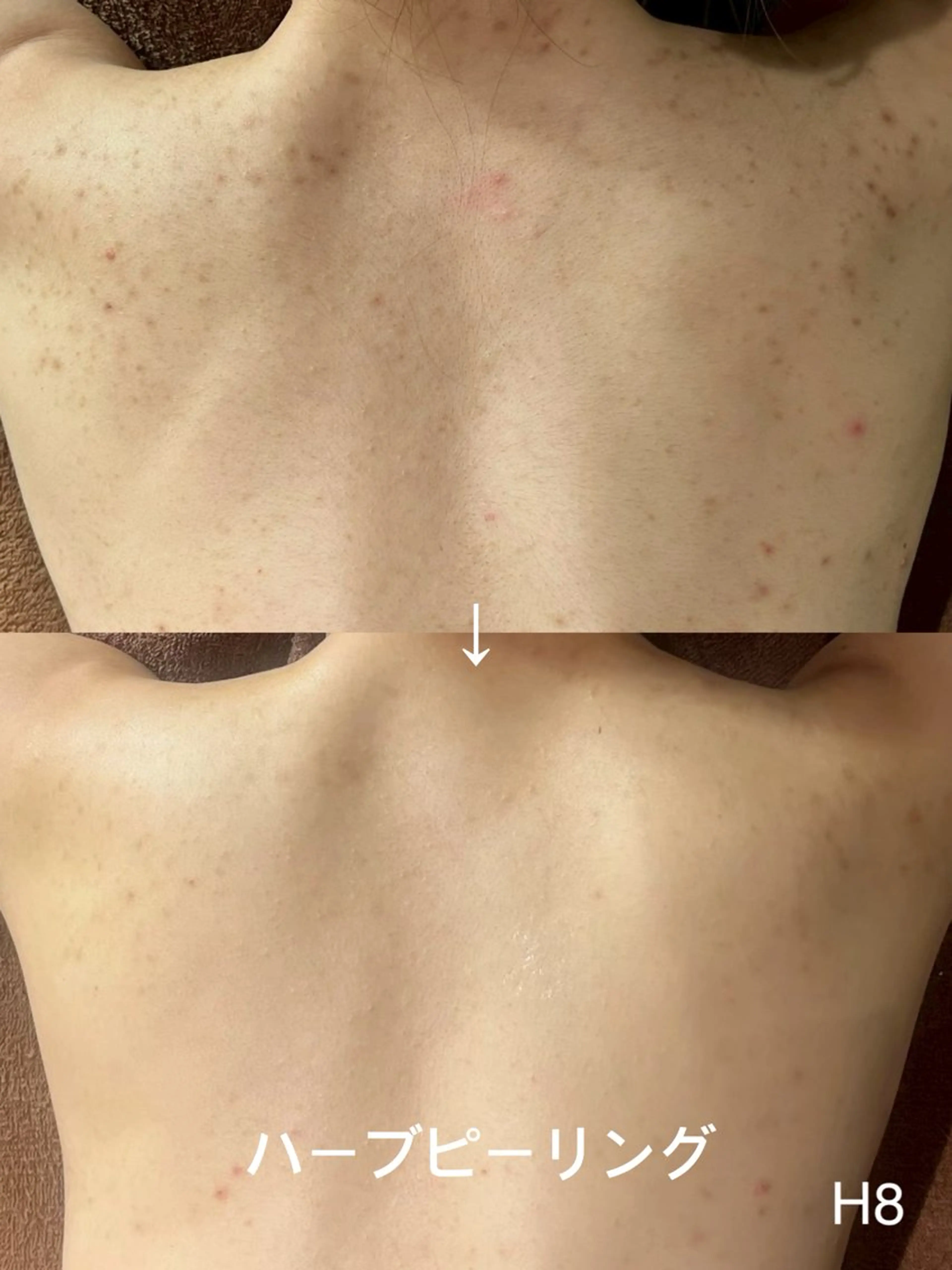 背中ハーブピーリング｜ニキビ・赤み・ざらつき集中ケアの写真