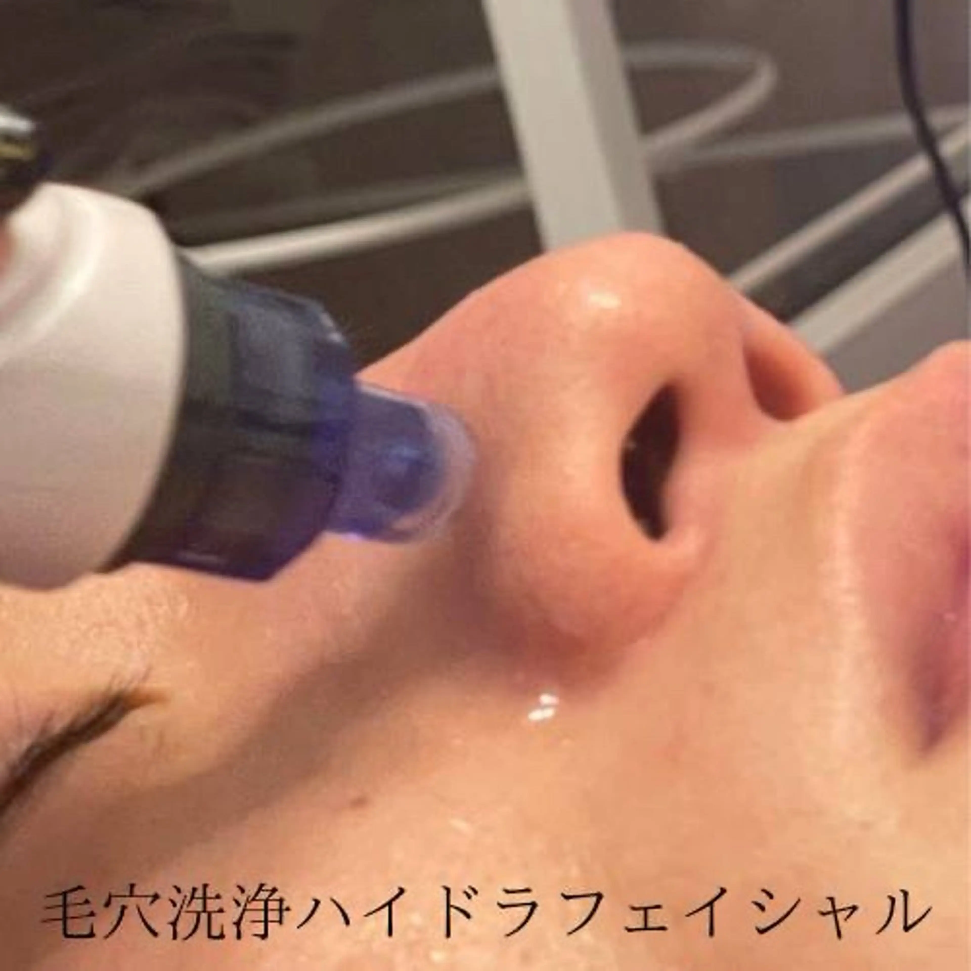 (初回限定)【毛穴汚れ/小鼻黒ずみ】ハイドラ毛穴洗浄(全顔) ¥12.800→¥5,500の写真