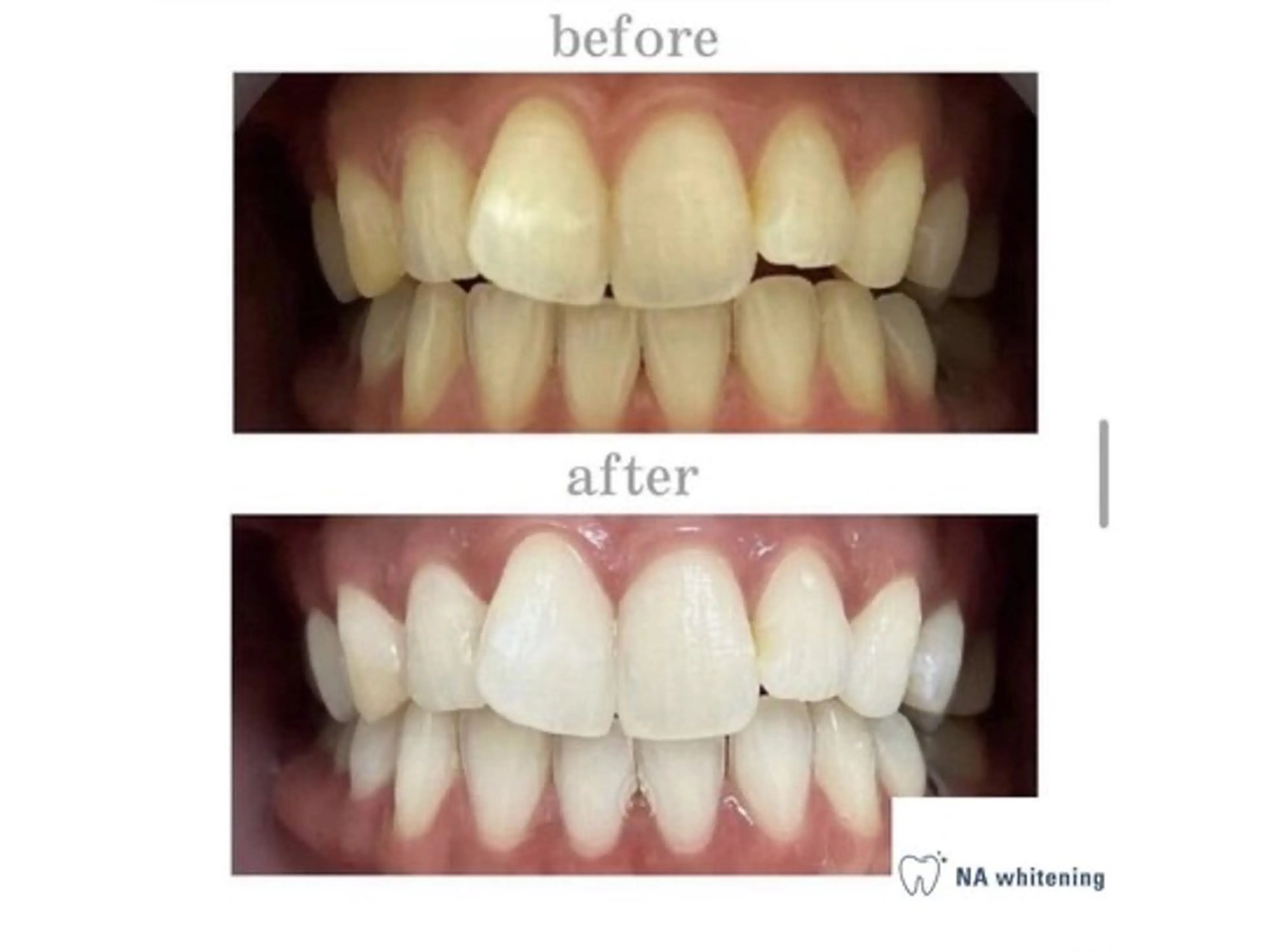 セルフホワイトニング🦷✨【30分照射】ミニモ限定価格の写真