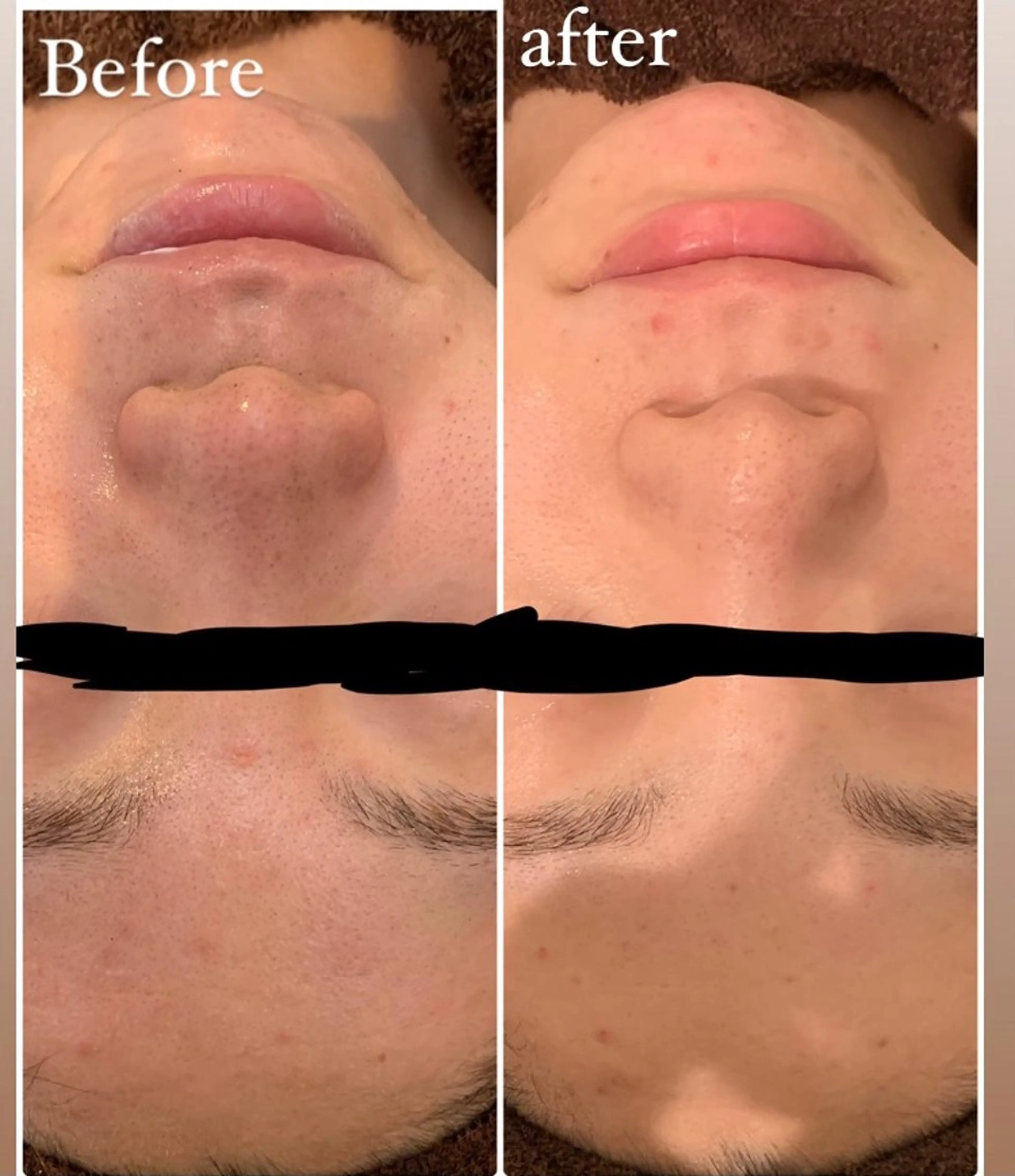 肌質改善ハーブピー リング🌿RINAのエステ・リラクイメージ