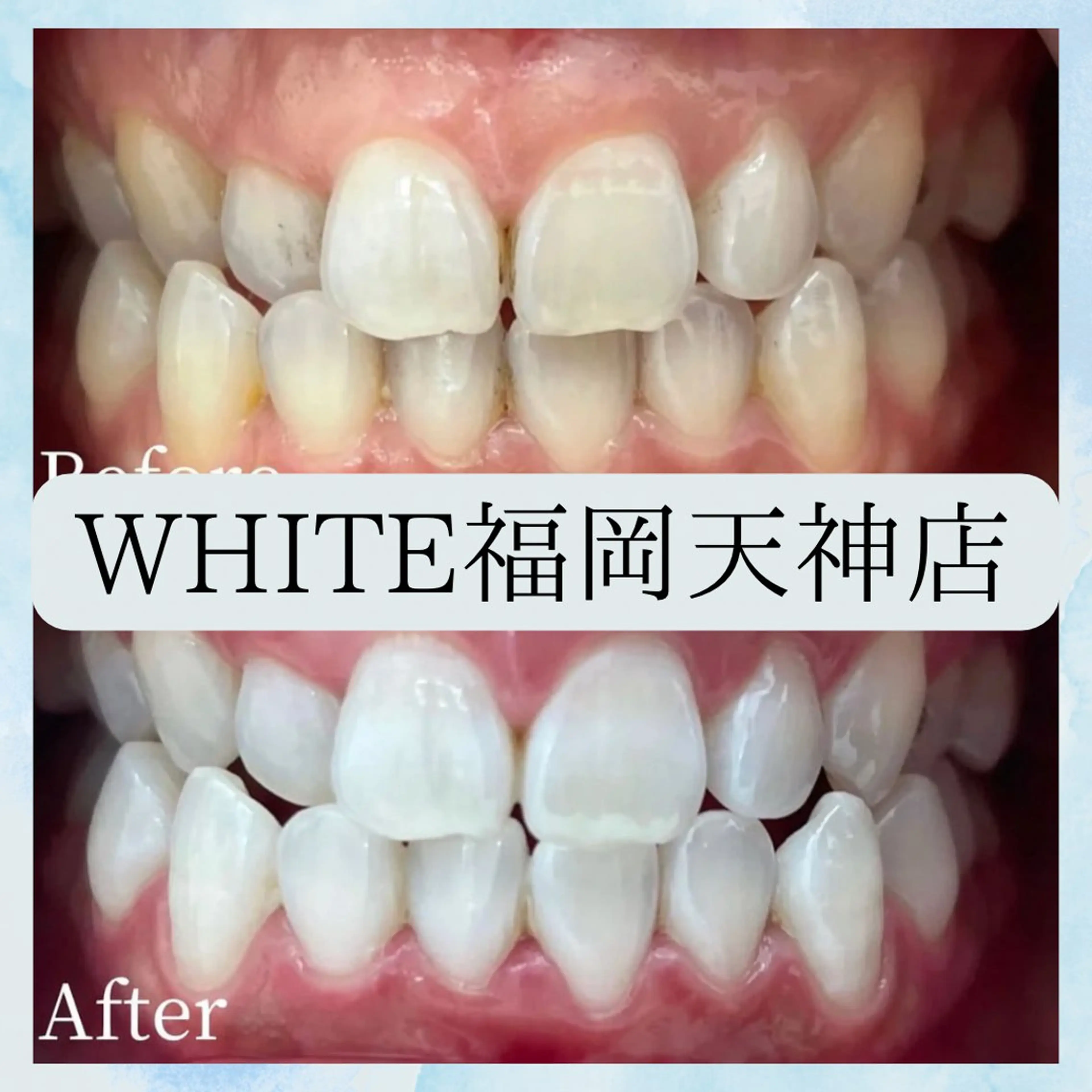 当日限定🌟セルフホワイトニング　15分×2回照射 ¥1880の写真