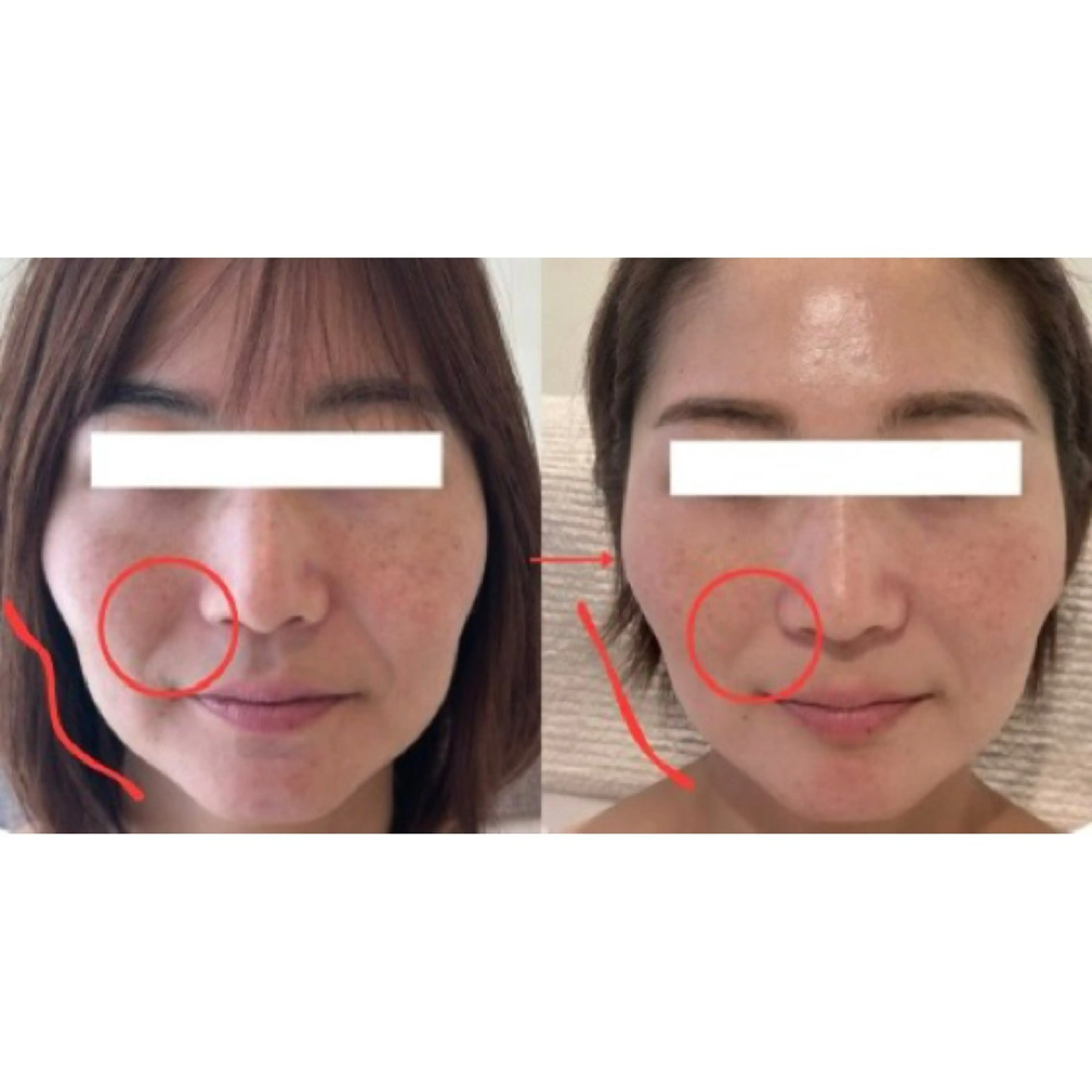 整形級小顔&ふっくらツヤ肌の写真