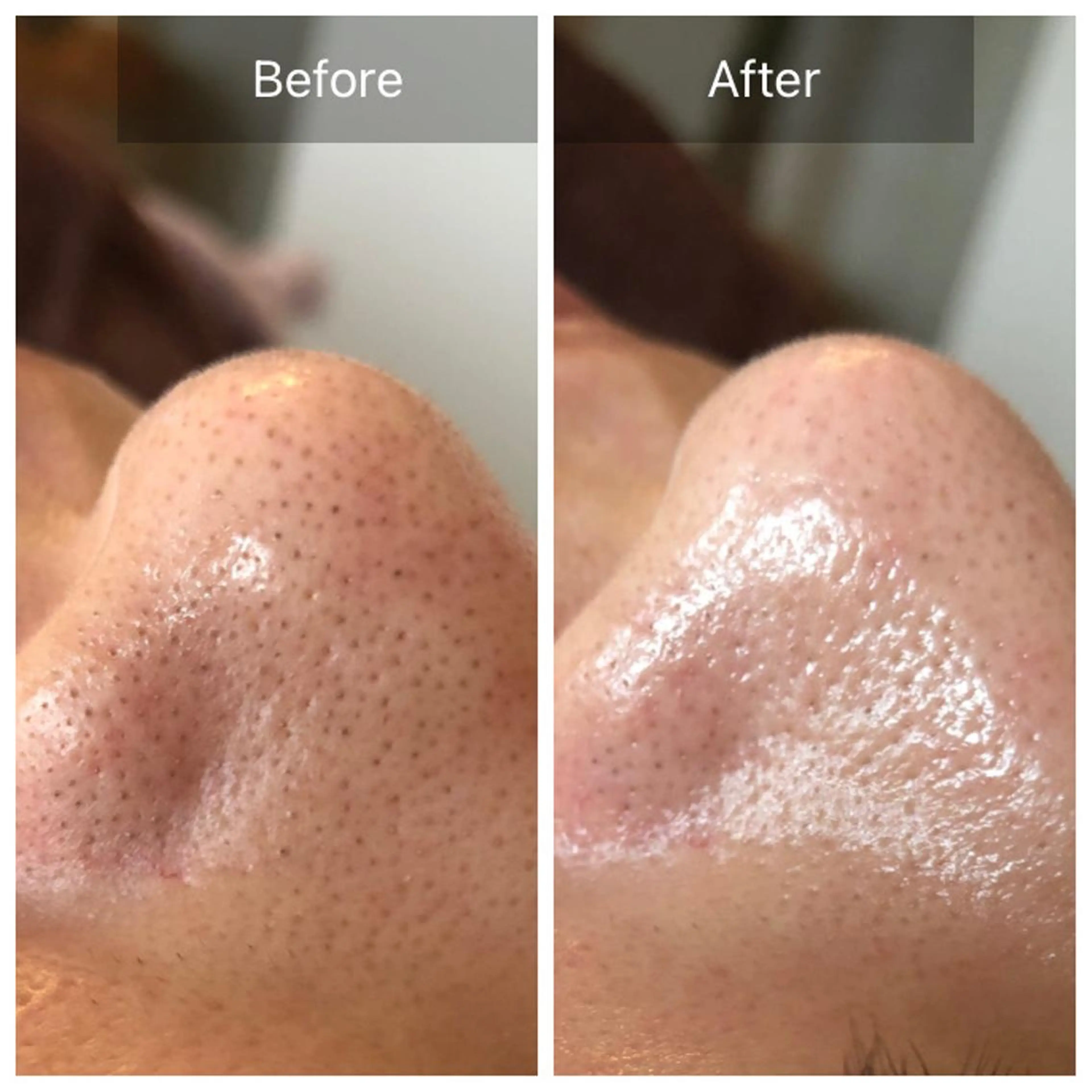 【いちご鼻解決☆角栓/黒ずみ】その場で汚れ取れる毛穴徹底洗浄の写真