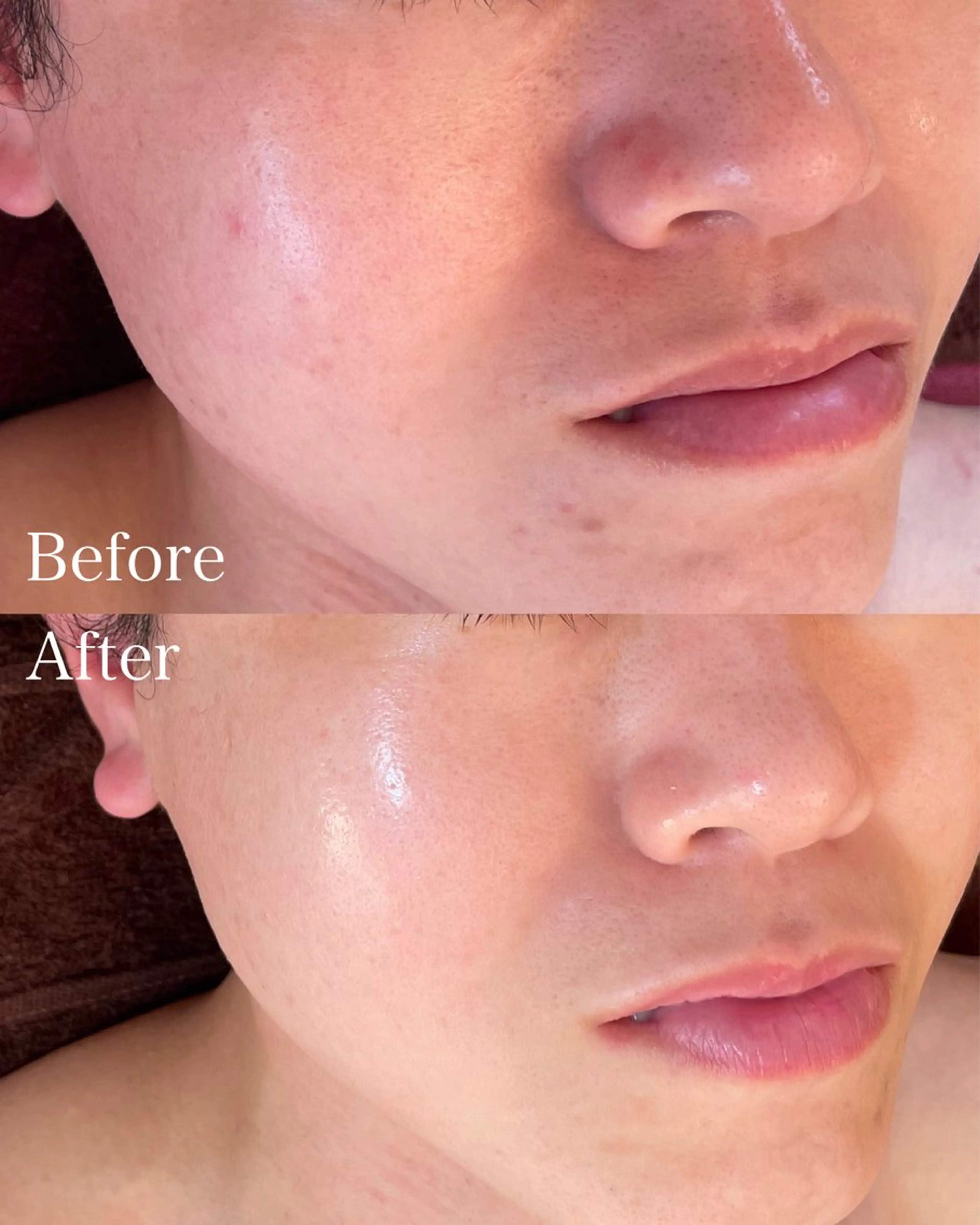 グリーンピールレスベラ2days《乾燥が気になるお肌の集中ケア！》の写真