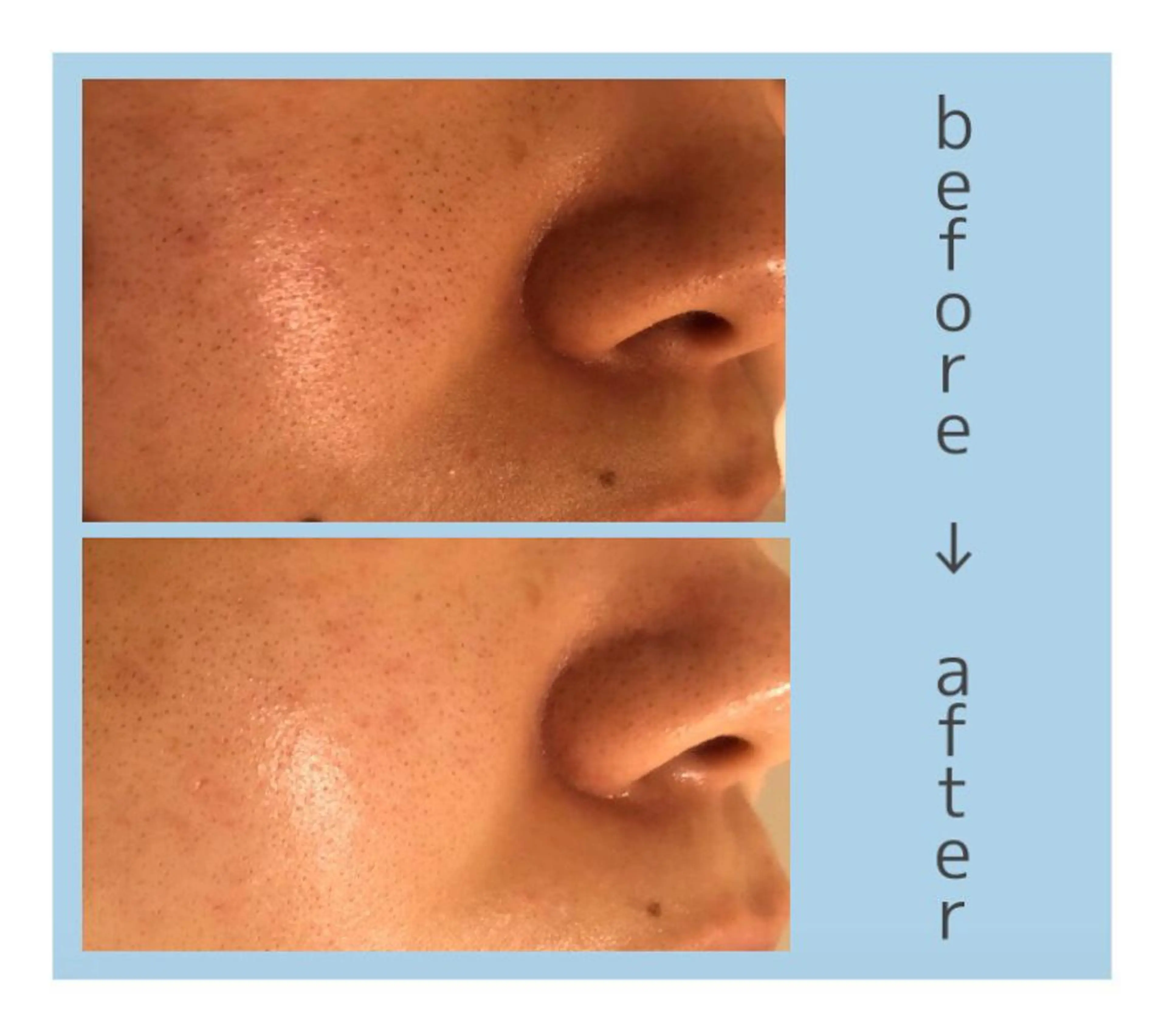 本日空きあり🌰🧡特別メニュー✨毛穴ケア、、脱マスクに1日2名限定💎の写真