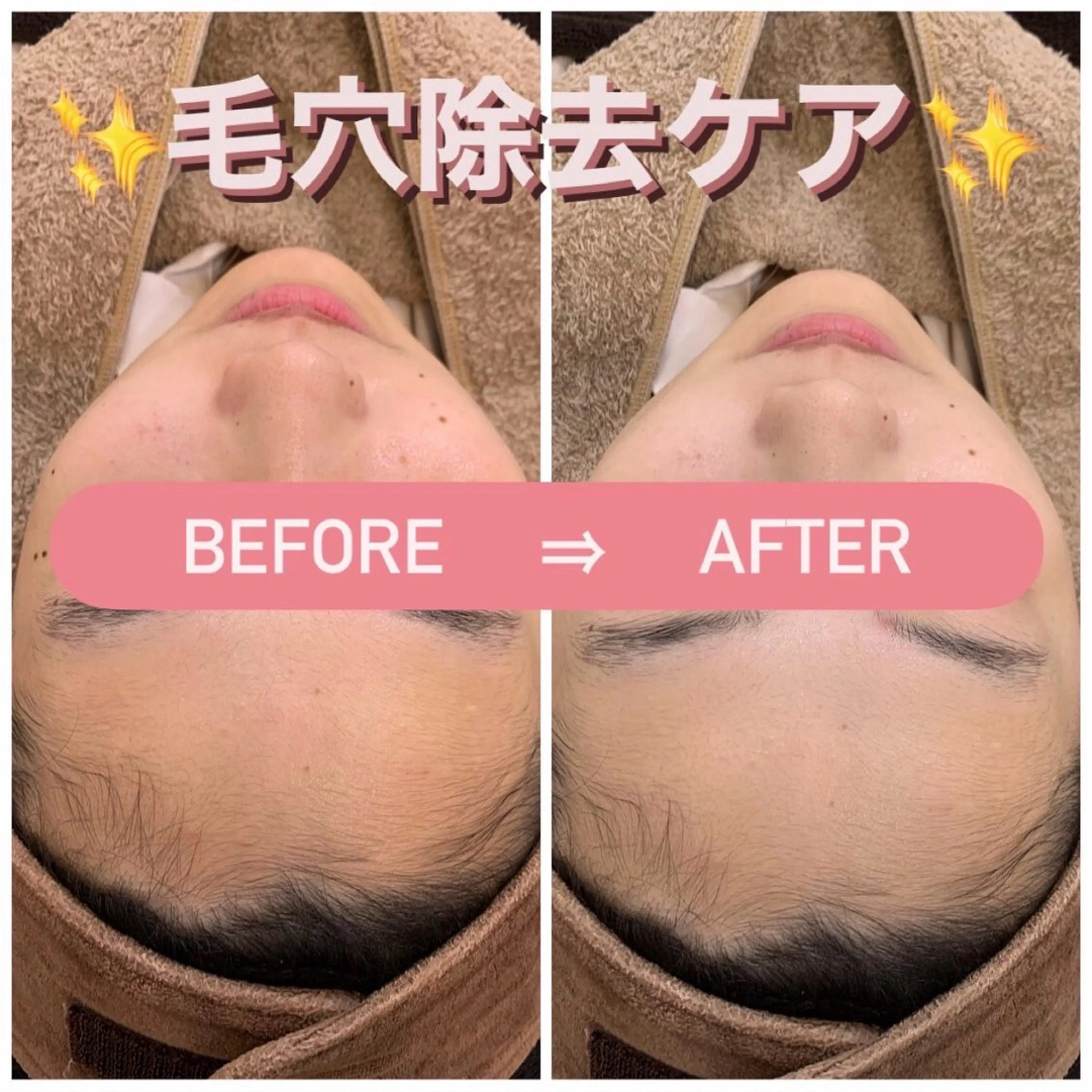 🩵毛穴コース🩵様々な機械を使ってザラつきの無い肌へ✨️✨乾燥/毛穴/黒ずみ/ピーリング/フェイシャルの写真