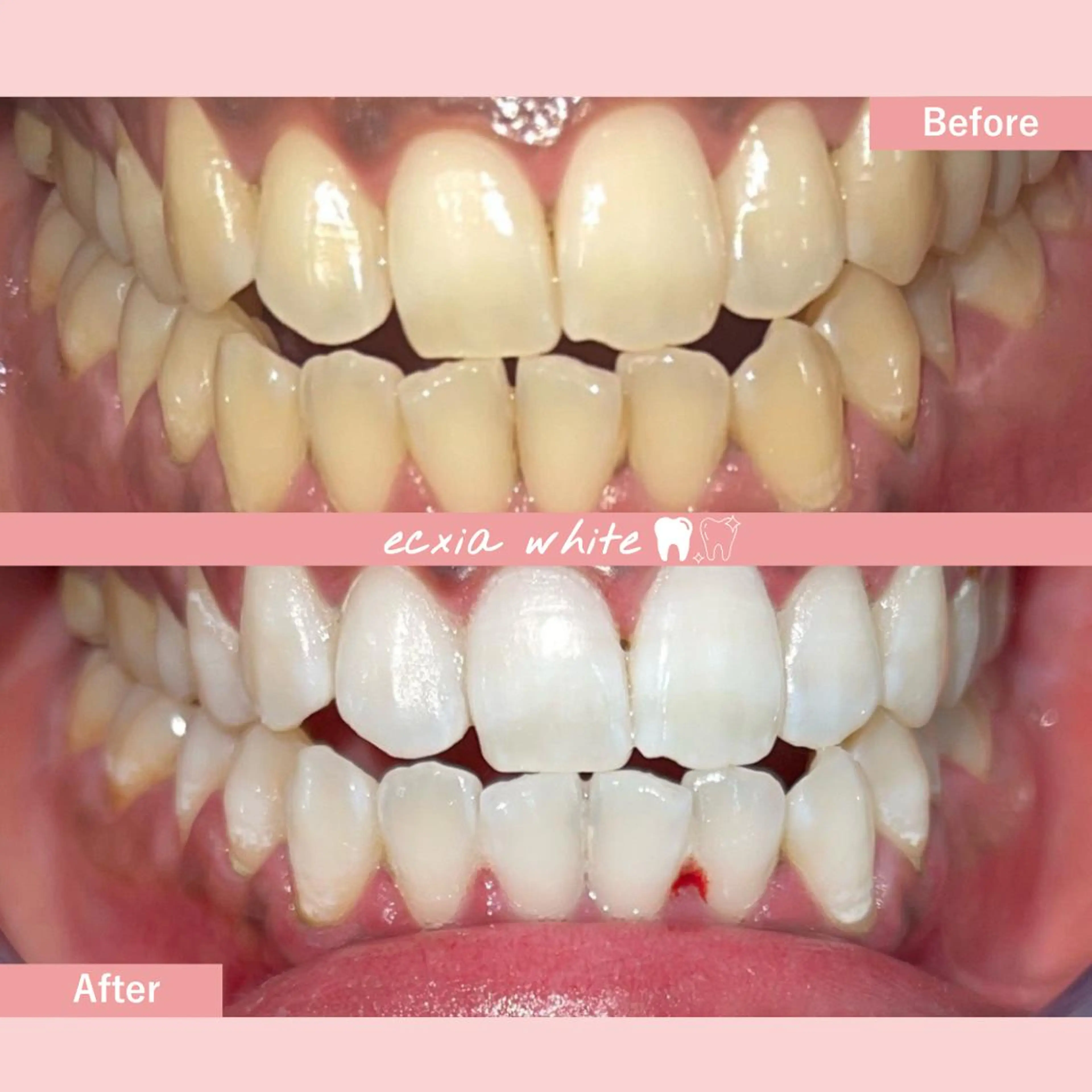 【医療提携ジェル付】6～7トーンUP◎ハイパワーホワイトニング 45分照射［中島公園駅/札幌/ホワイトニング/すすきの］の写真