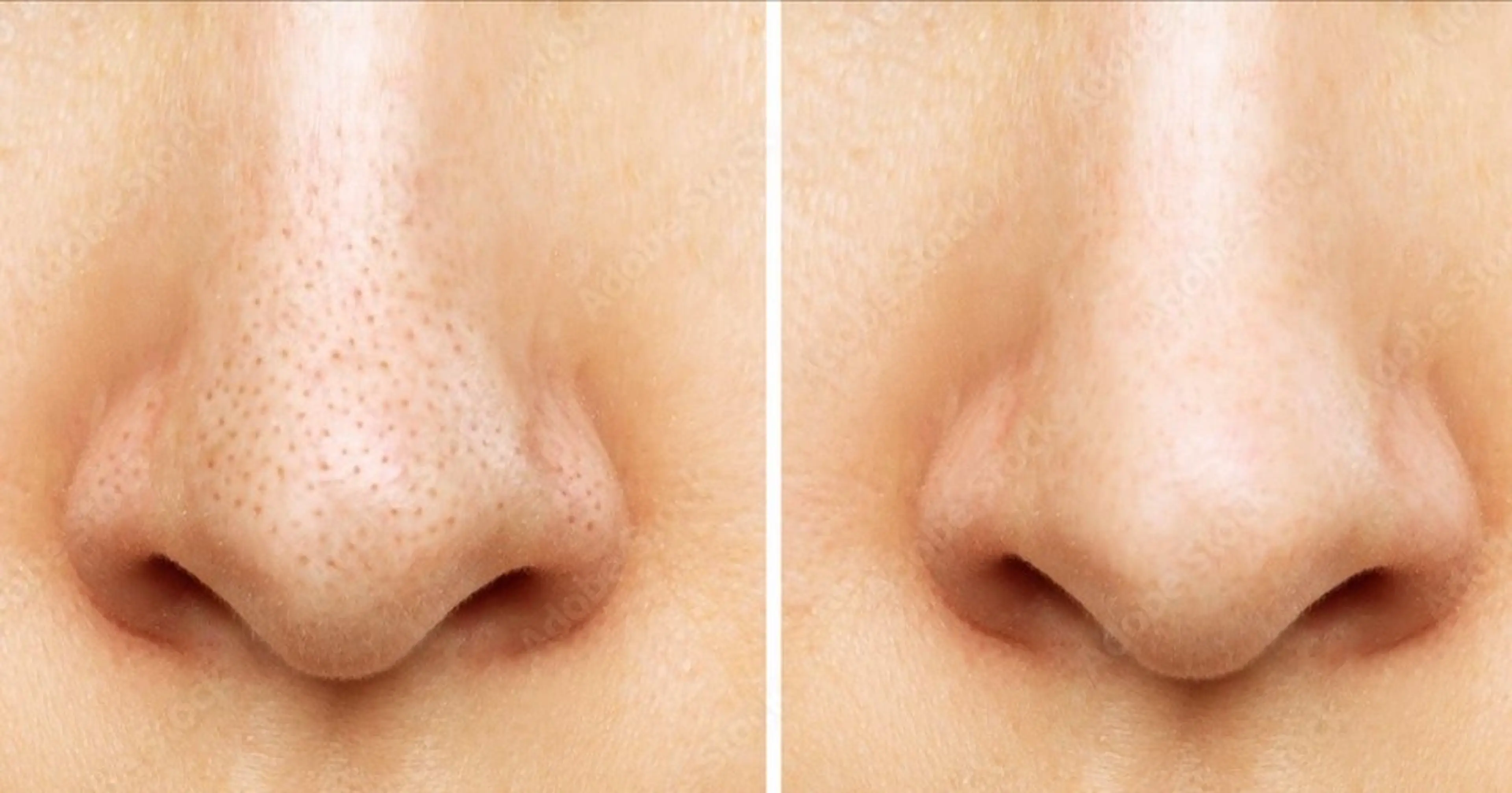 【毛穴黒ずみ改善！】ハイドラフェイシャル毛穴洗浄￥5000の写真