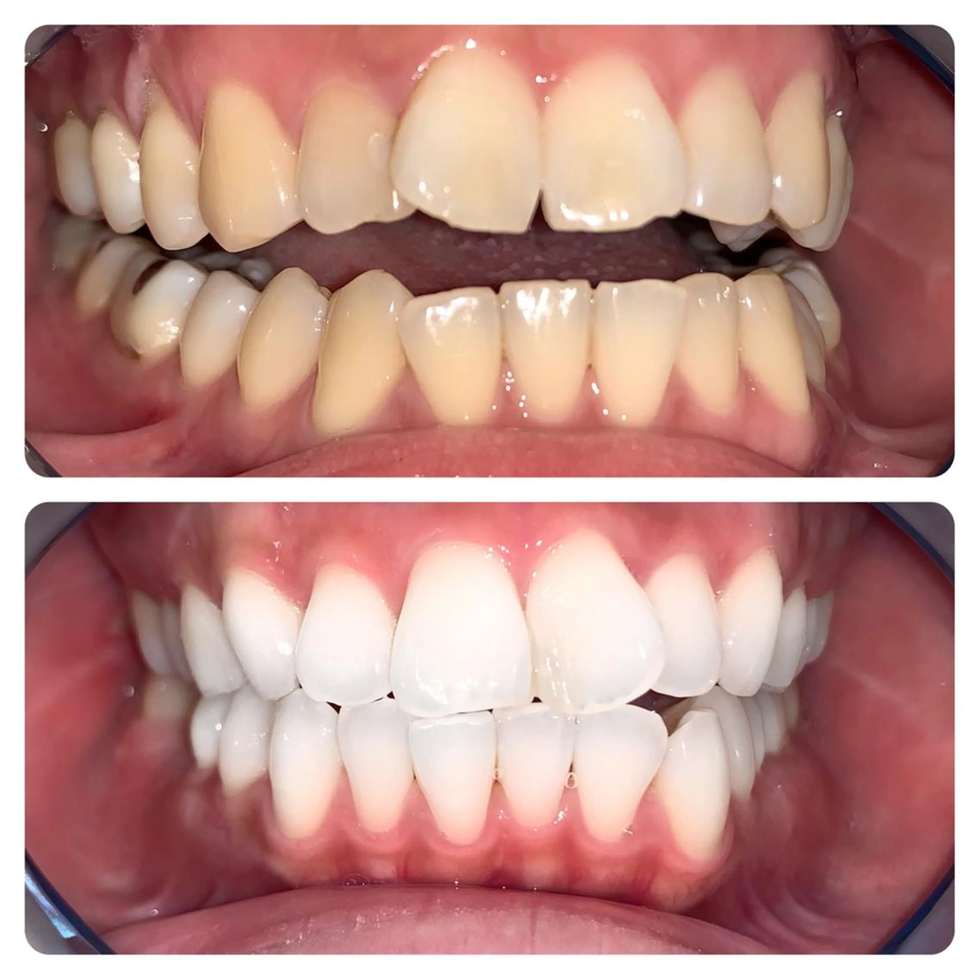 【人気No.1】Wプレミアムホワイトニング 4来店計160分照射 徹底的な白さへ✨の写真