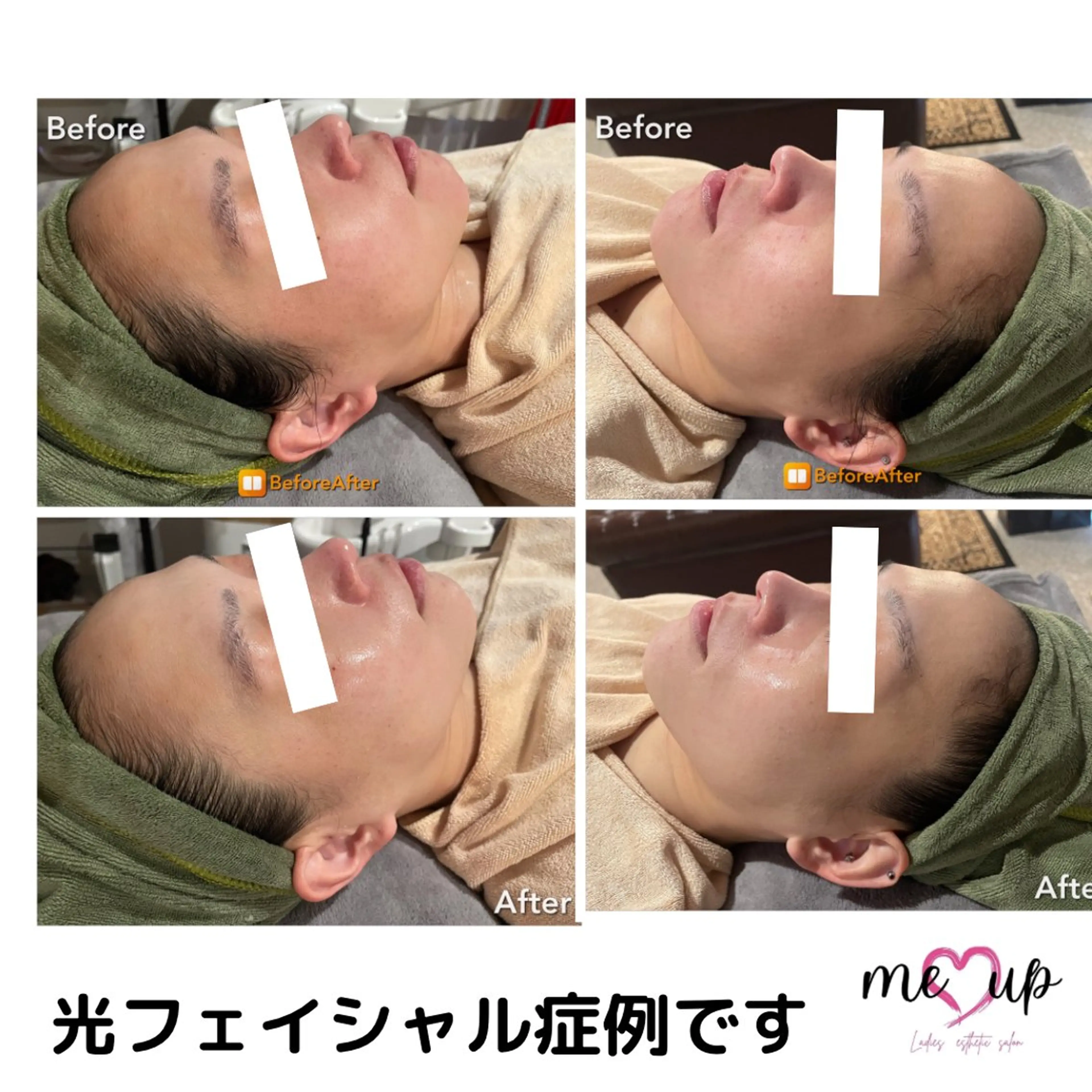 エステ Meupニキビ専門店 背中/ハーブ/肌管理のその他イメージ