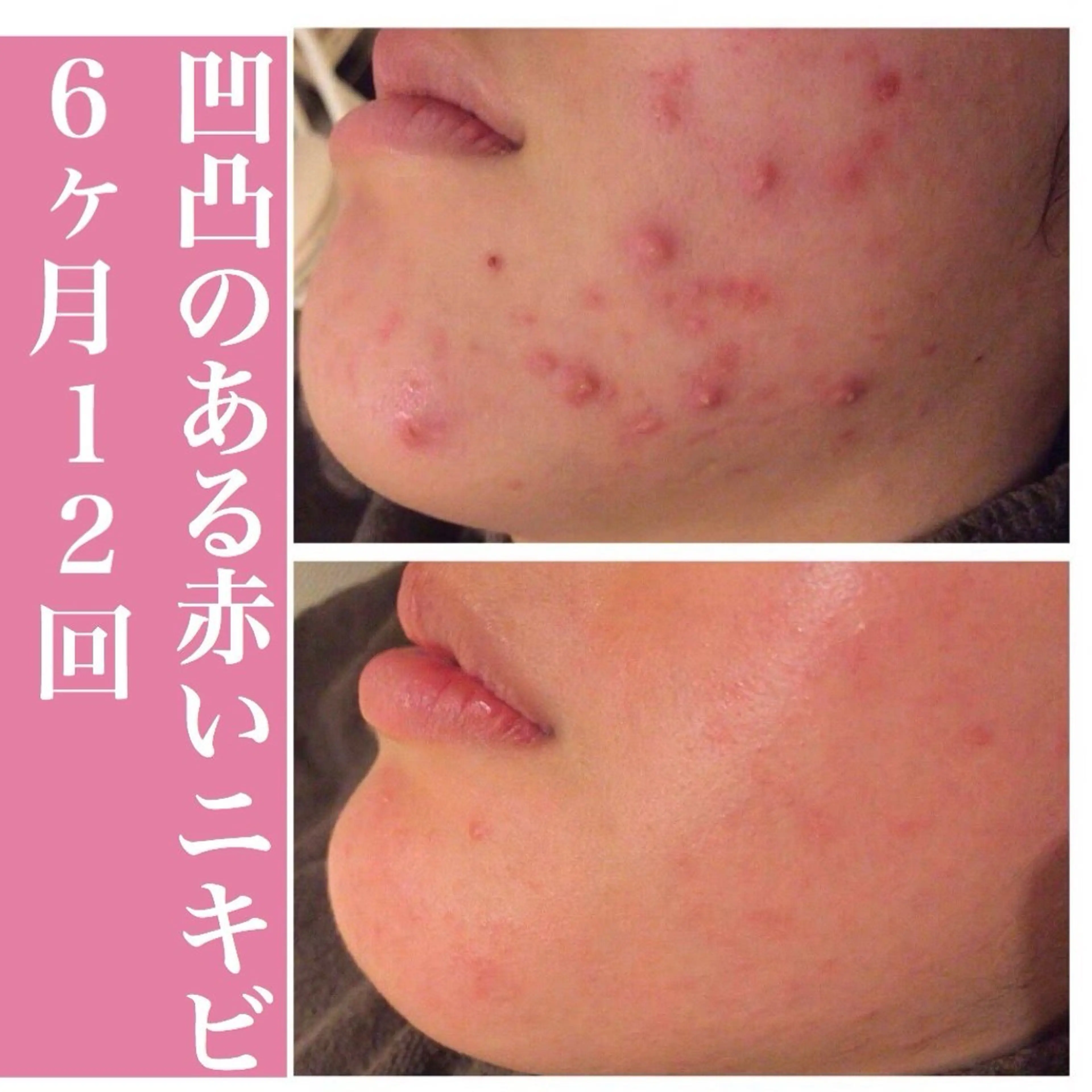 エステ リラク ニキビ跡改善専門🔥 医療にはできない改善のエステ・リラクイメージ