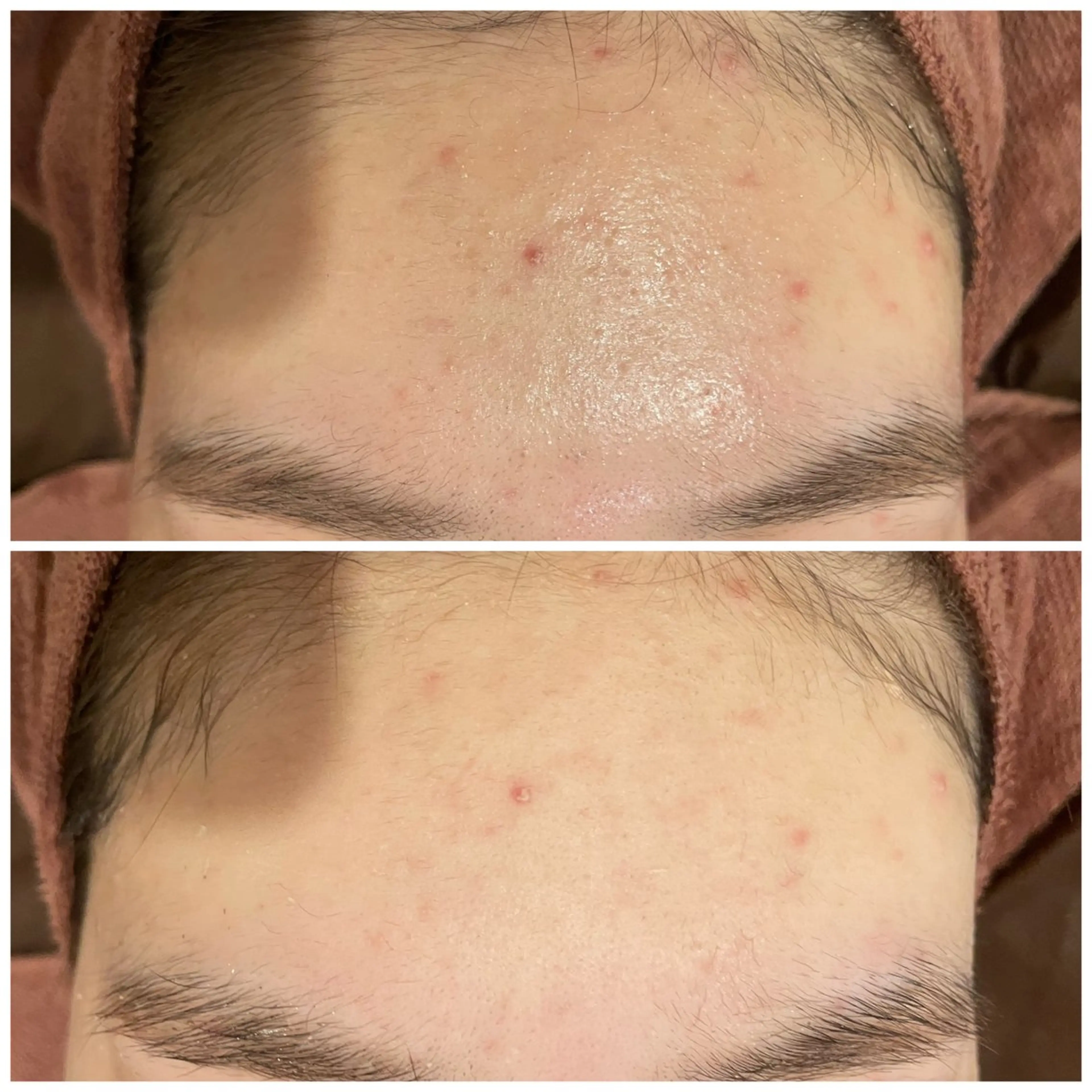 ニキビ特化型エステ 🍓最短で肌質改善のその他イメージ