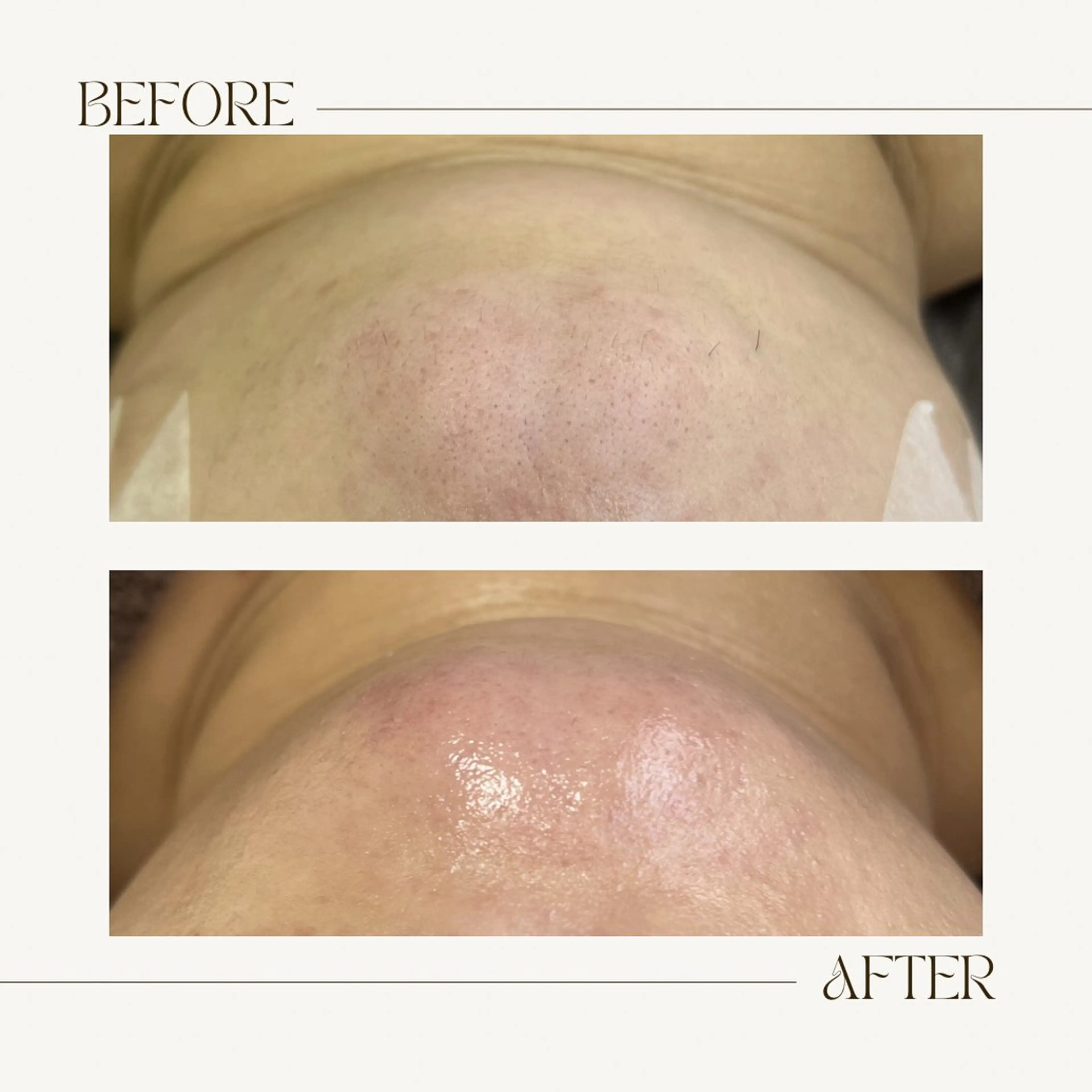 脱毛 1st｜フェイシャル エステ専門店のエステ・リラクイメージ