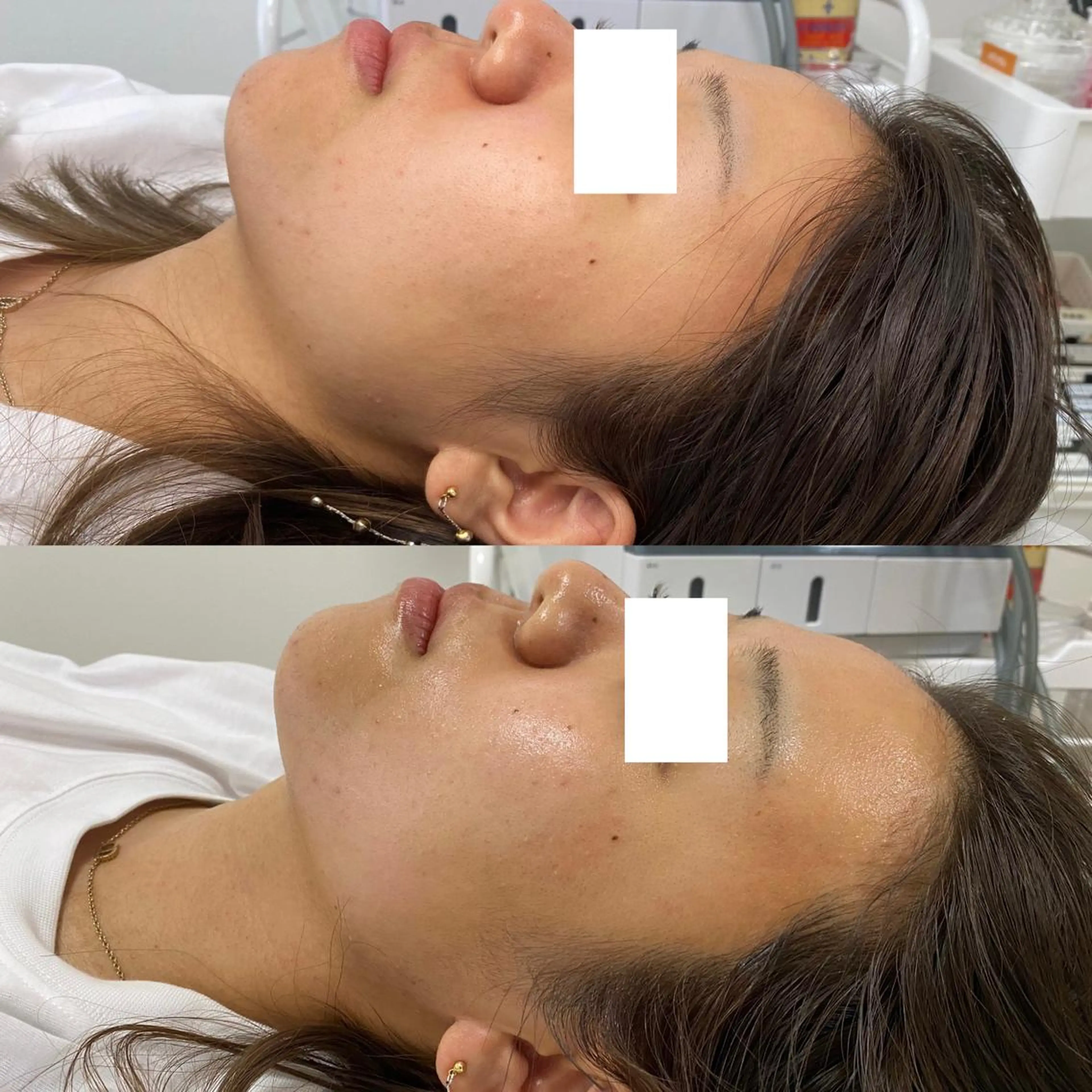 「3回まで利用可能！」リフトアップ・肌質改善・SPの写真