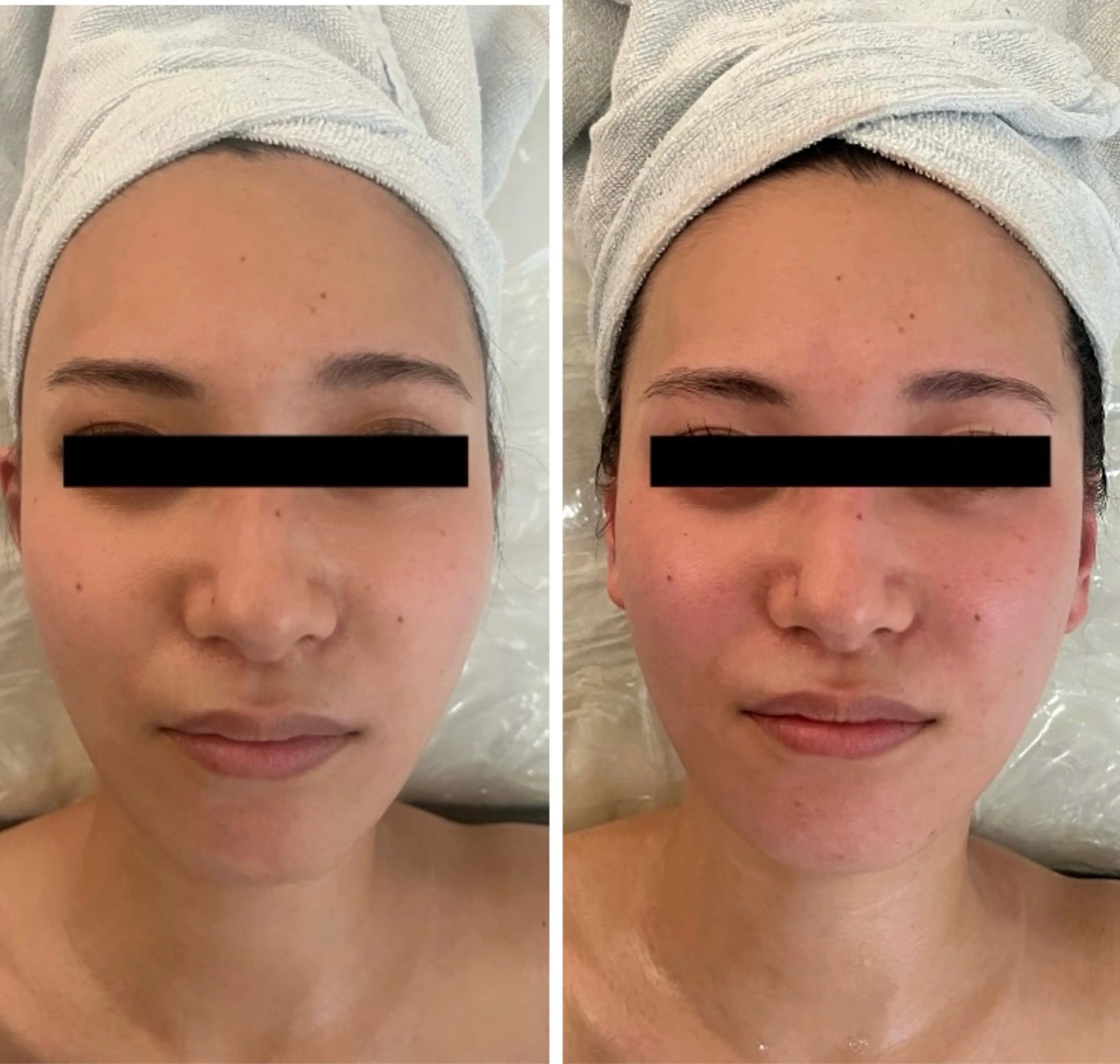 M.plus所属・水光韓国肌ハーブ ピーリングMplusのエステ・リラクイメージ