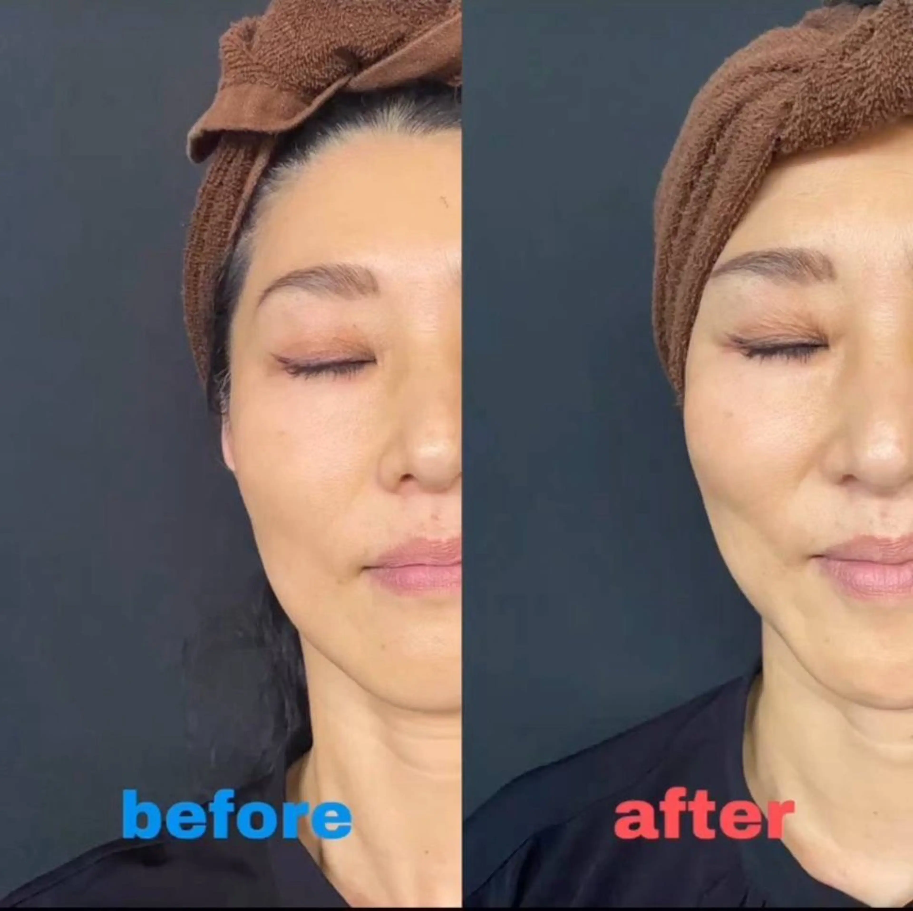 光フェイシャルの写真