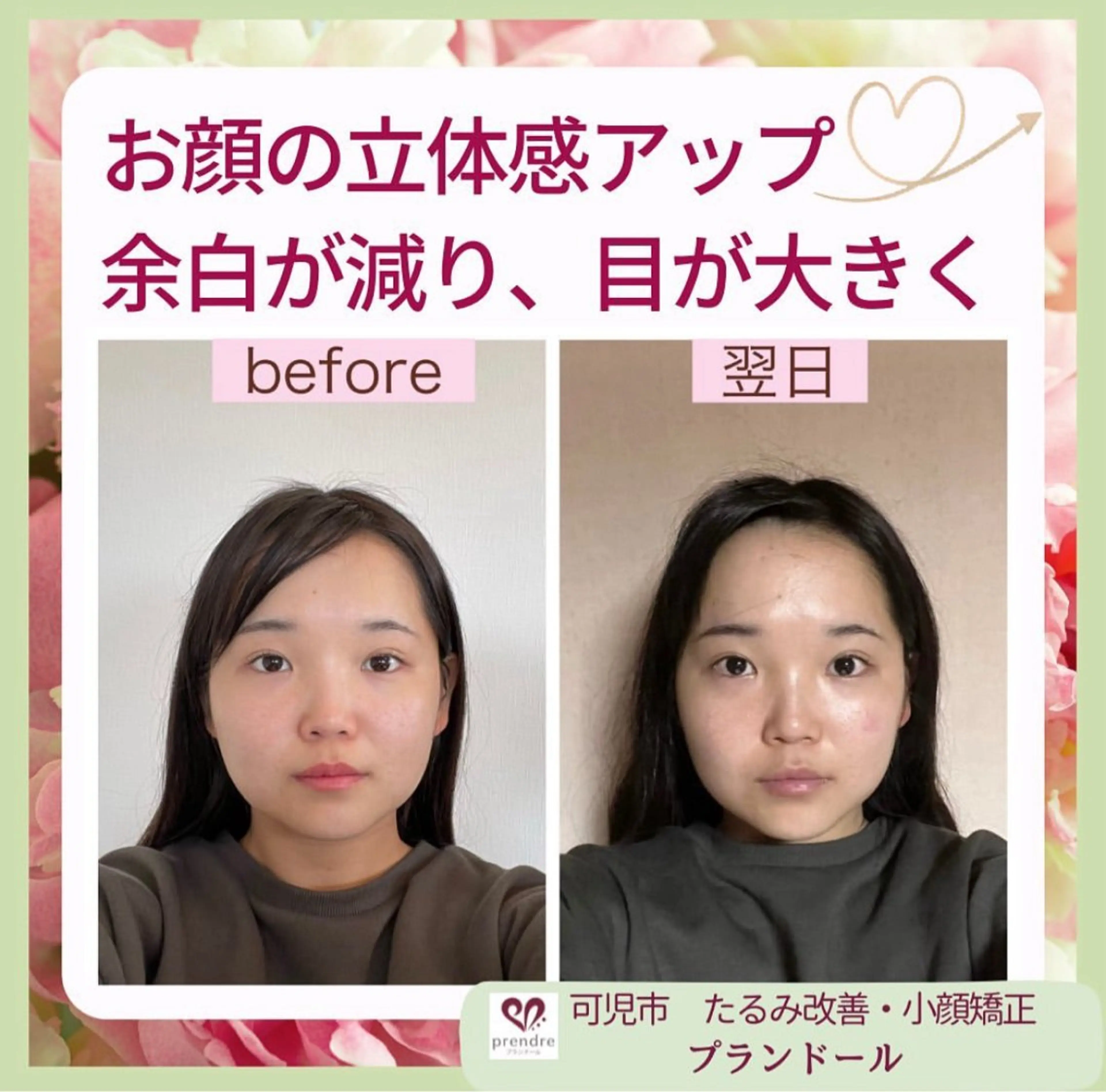 リフトアップ小顔 プランドール所属・痛くない小顔矯正 いまいあやののその他イメージ