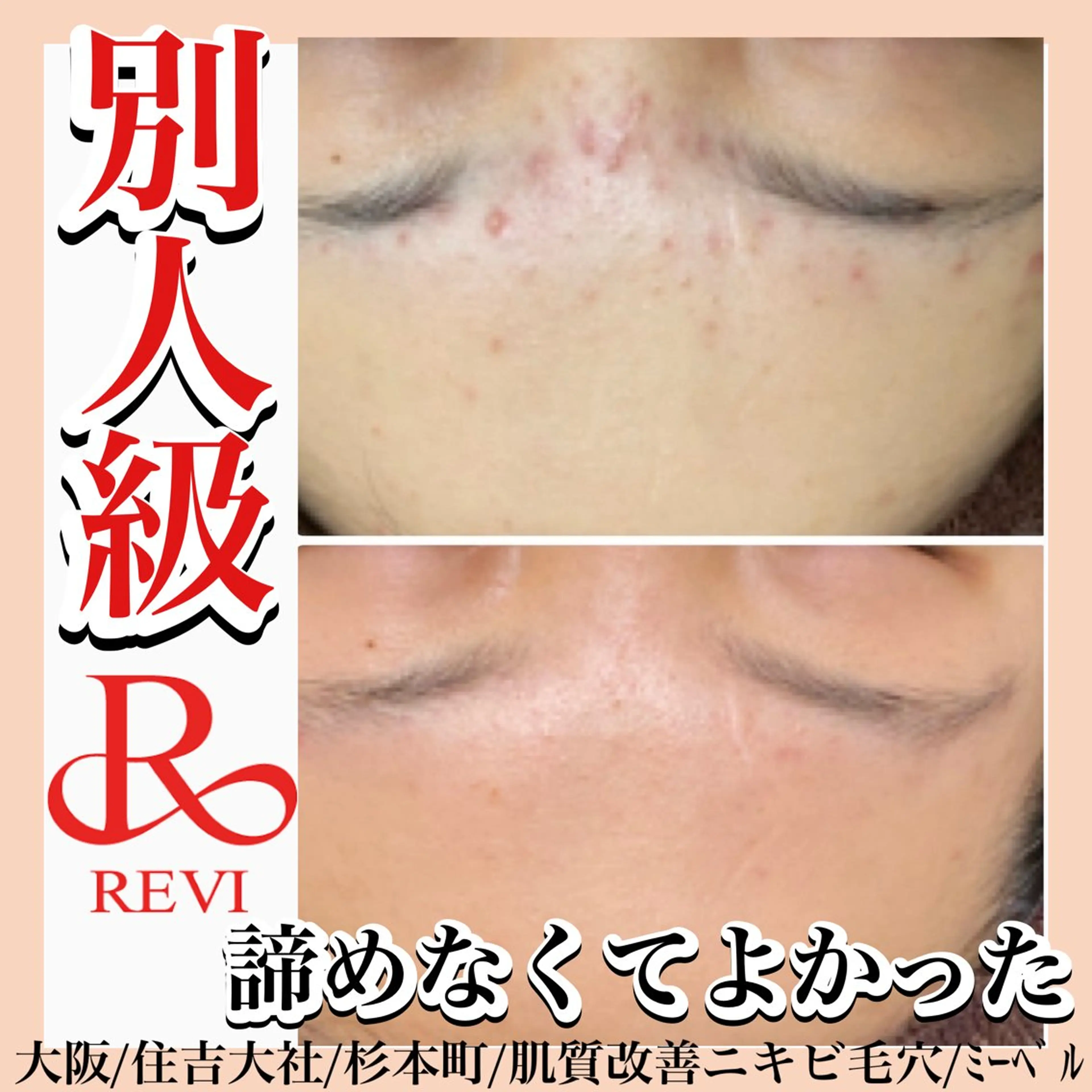 【初回】陶肌トリートメント(ハーブピーリング)ニキビ毛穴シミなど◎植物幹細胞配合ホームケア半額体験付の写真