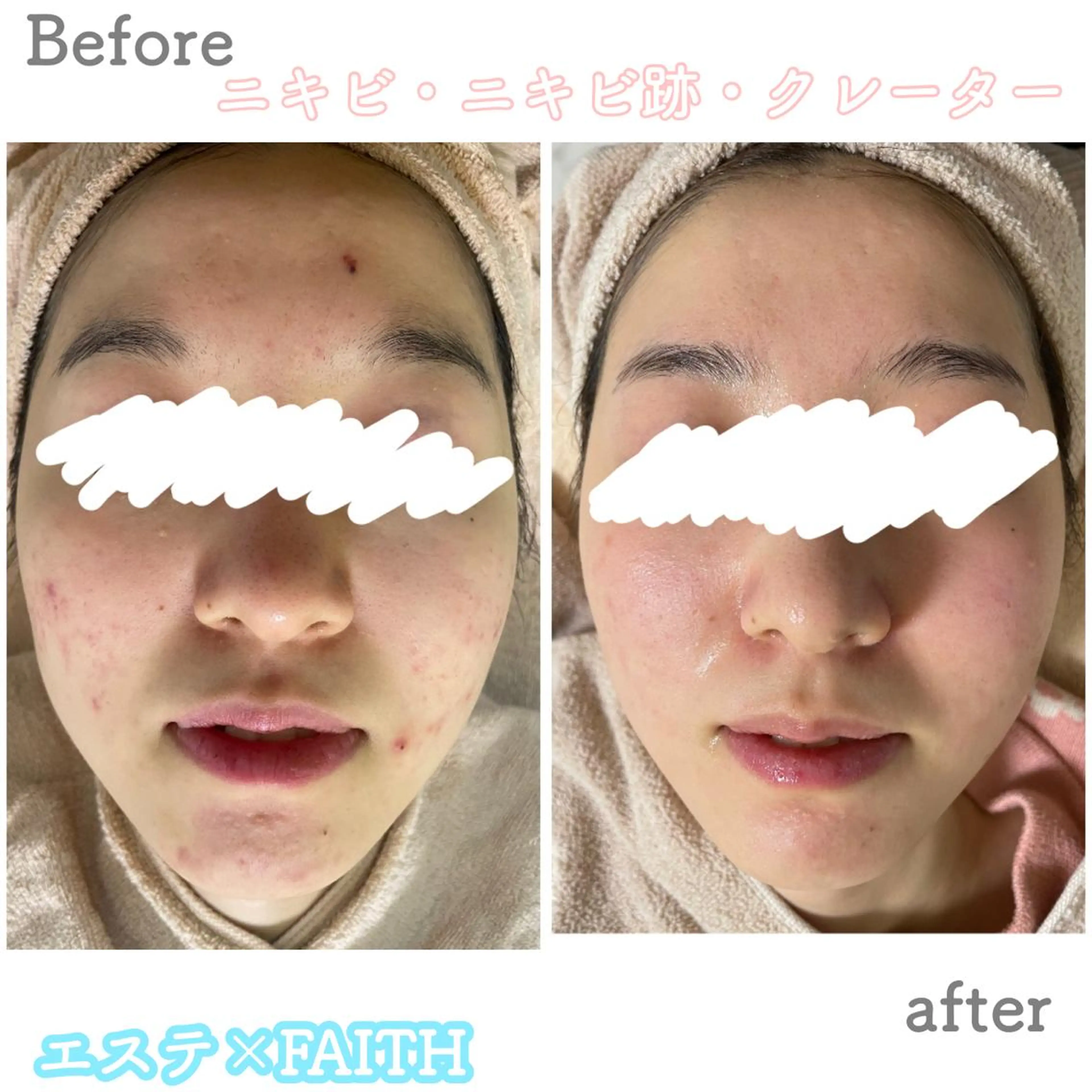 ショート カラー パーマ ヘアアレンジ メンズ キッズ ネイル マツエク・マツパ アイブロウ エステ ニキビ&跡改善サロン オーナー光木のエステ・リラクイメージ