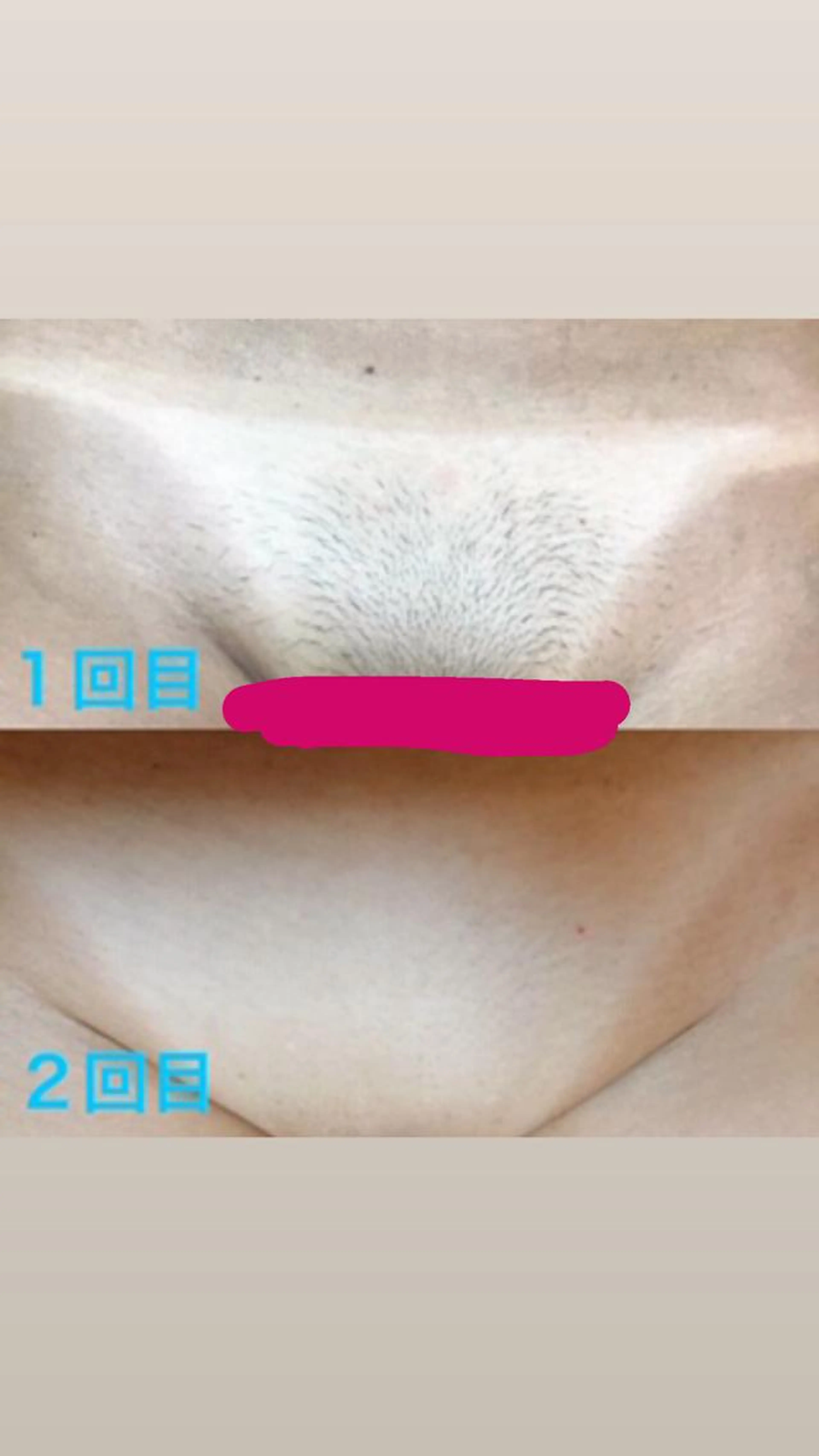 vio脱毛 粘膜キワキワまで全て照射の写真