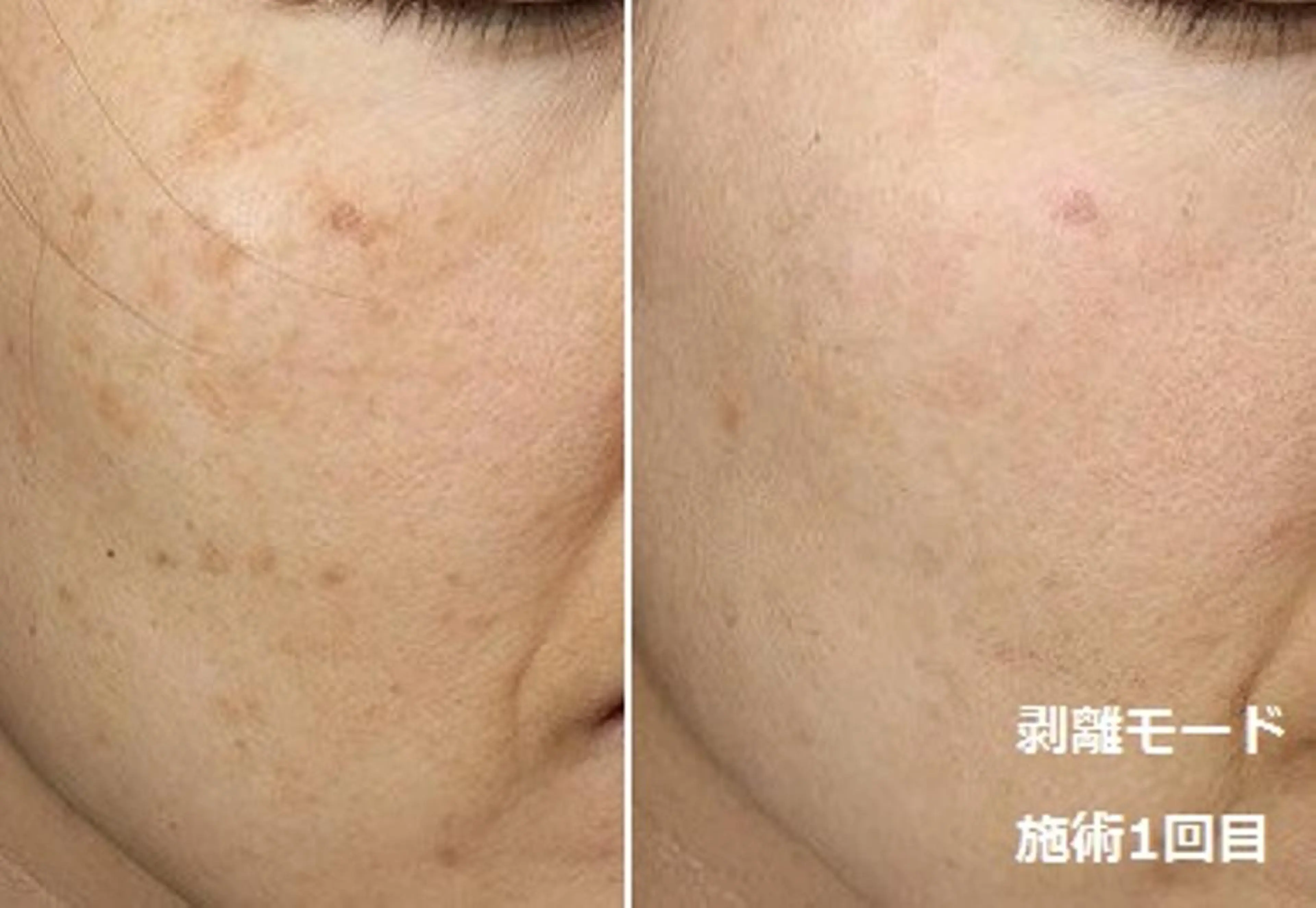 エステ 顔脱毛＆毛穴＆ニキビ 優良№1♪ヒロコ♪のエステ・リラクイメージ