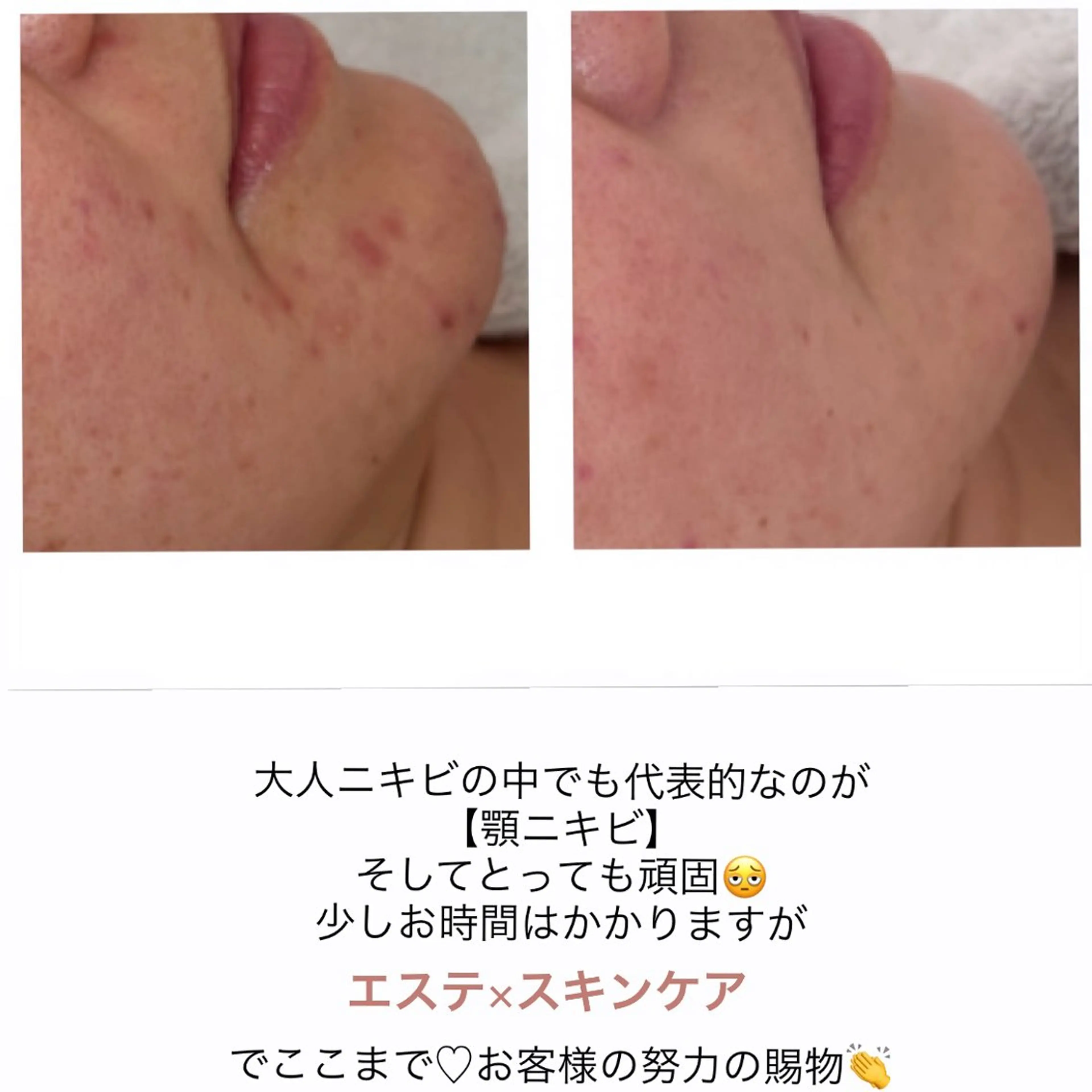 エステ ニキビ/敏感肌/乾燥 Lilyauraのエステ・リラクイメージ