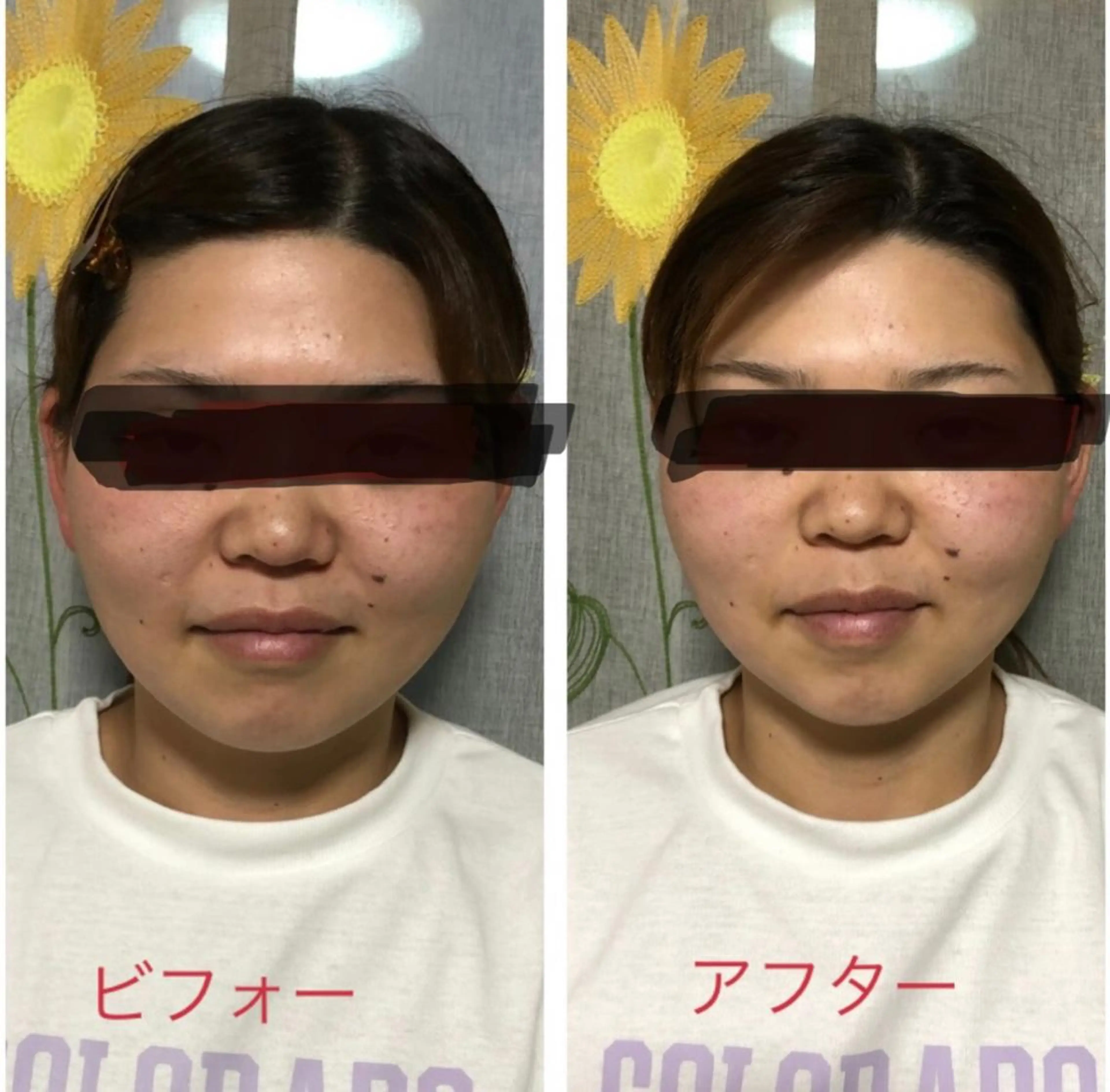 🌻ミニモ限定🌻小顔コースの写真