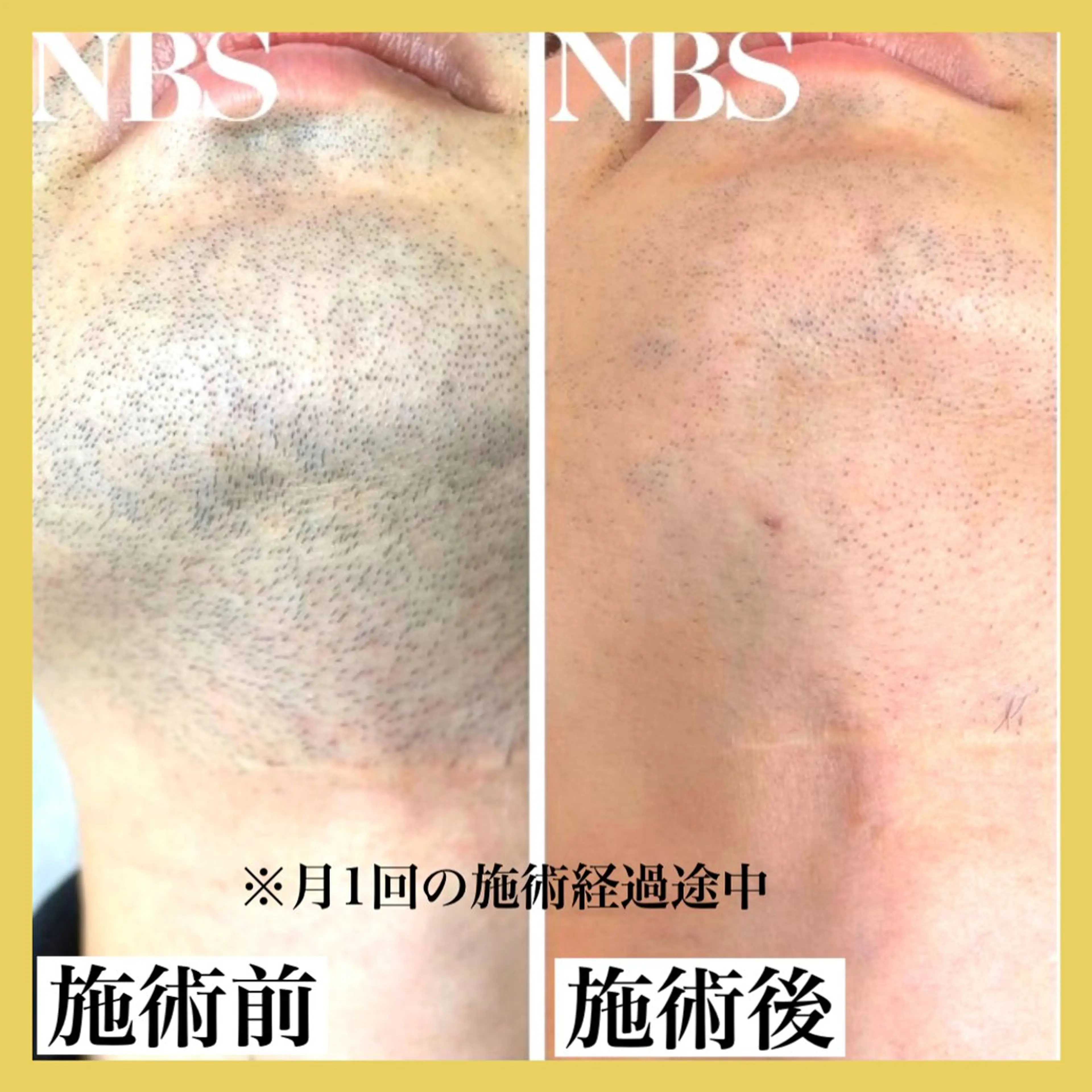 メンズ epismoo 脱毛/HBL/毛穴の眉毛・アイブロウイメージ