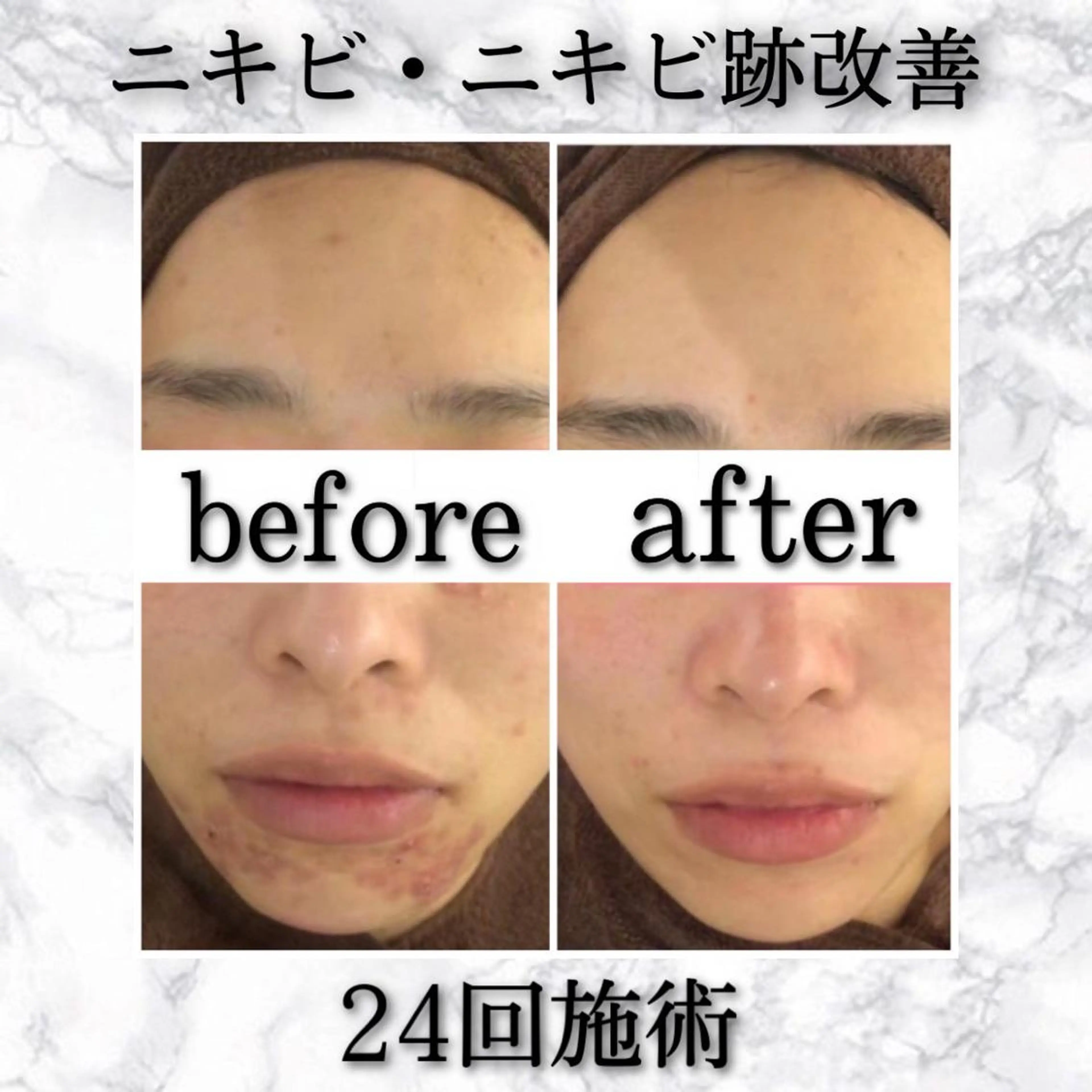 ショート カラー パーマ ヘアアレンジ メンズ キッズ ネイル マツエク・マツパ アイブロウ 夏までに肌荒れ卒業 するサロン🌻のエステ・リラクイメージ