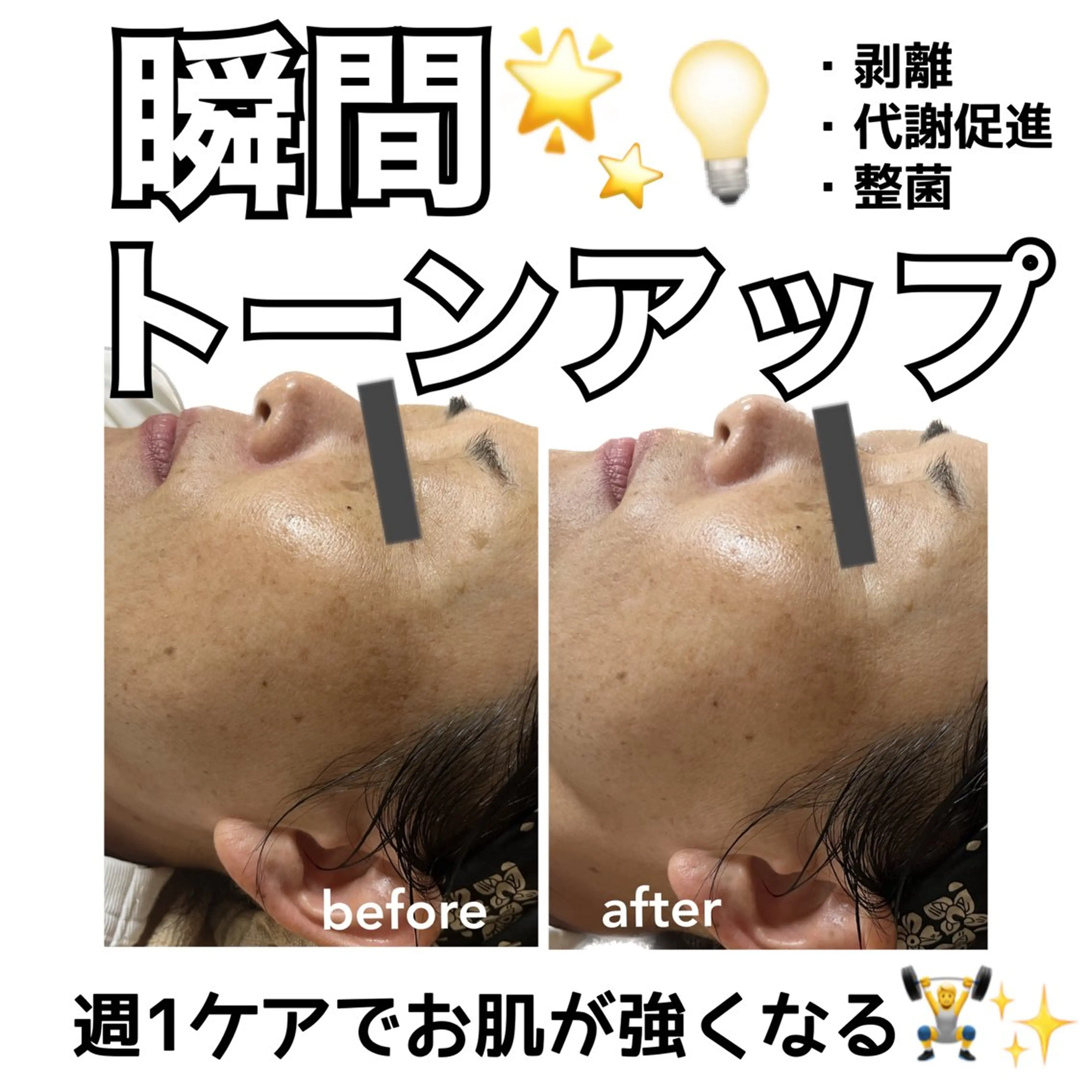 【肌質改善🫧】繰り返す肌トラブルを改善！気になる毛穴の汚れや角栓にも！美白透明感UP/剥離なしピーリングの写真