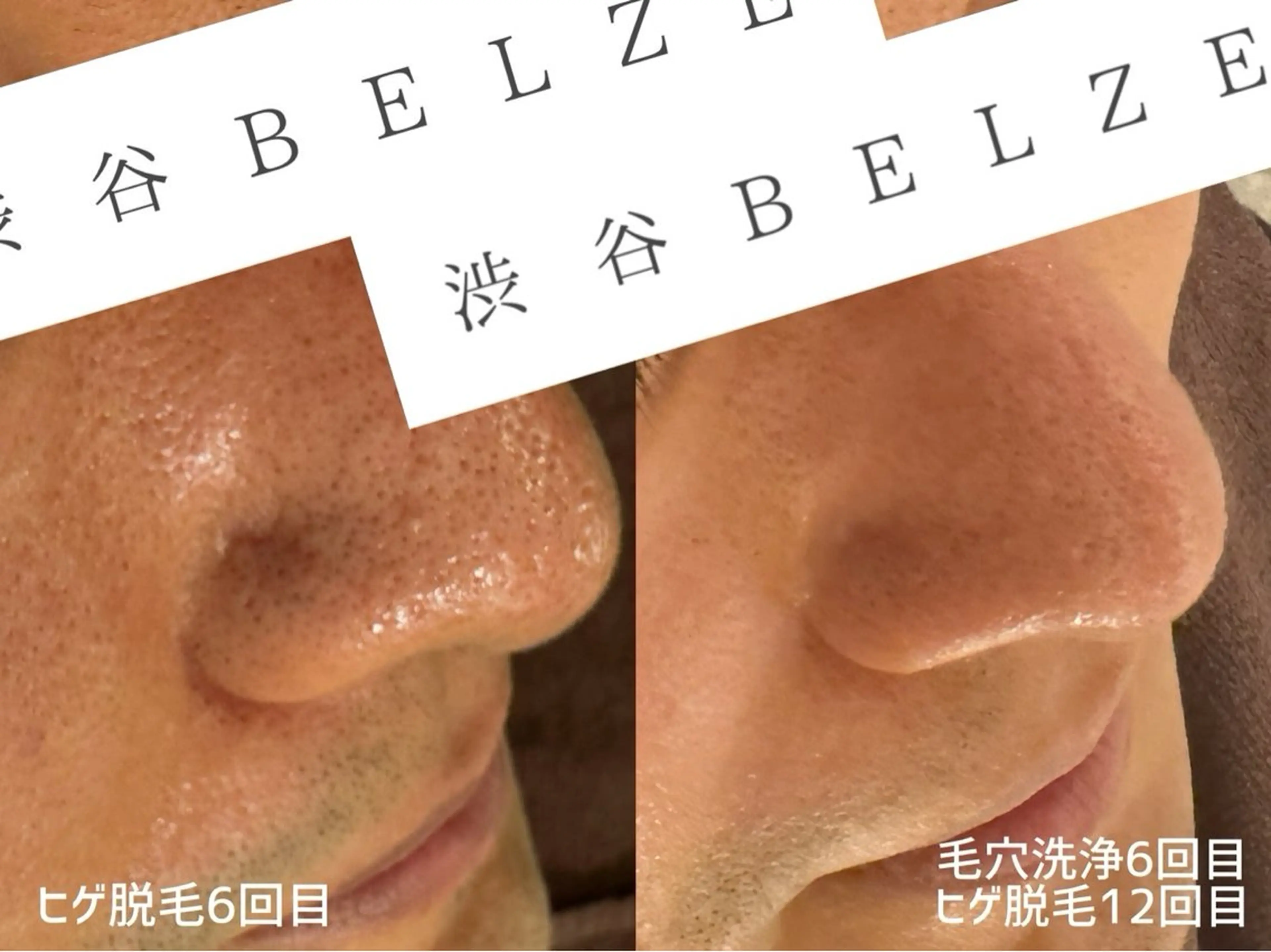 渋谷ベルゼ🌷木下 毛穴/脱毛/フェムのその他イメージ