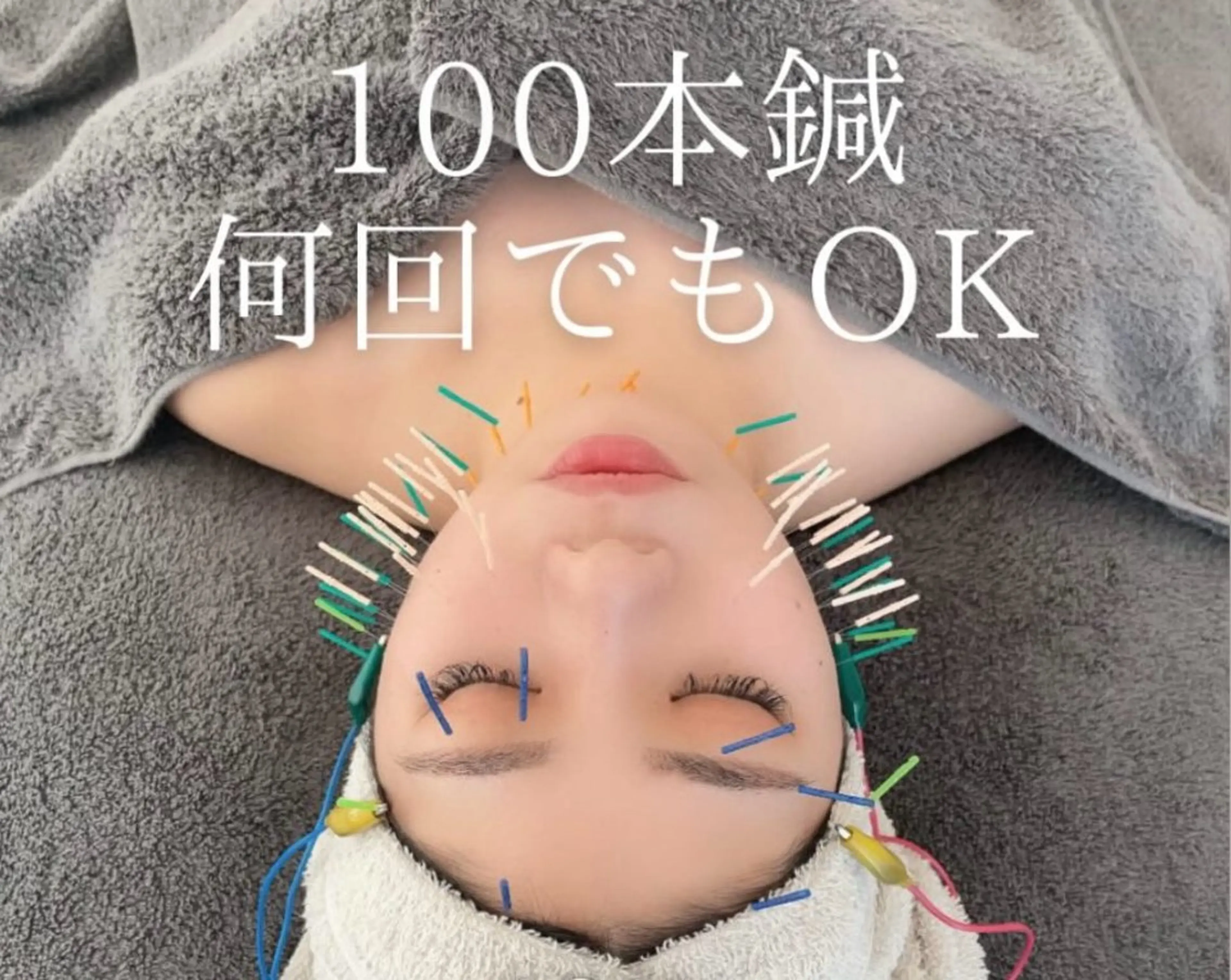 【18:00~以降限定】100本美容鍼✨通常¥13,000→¥7,700！の写真