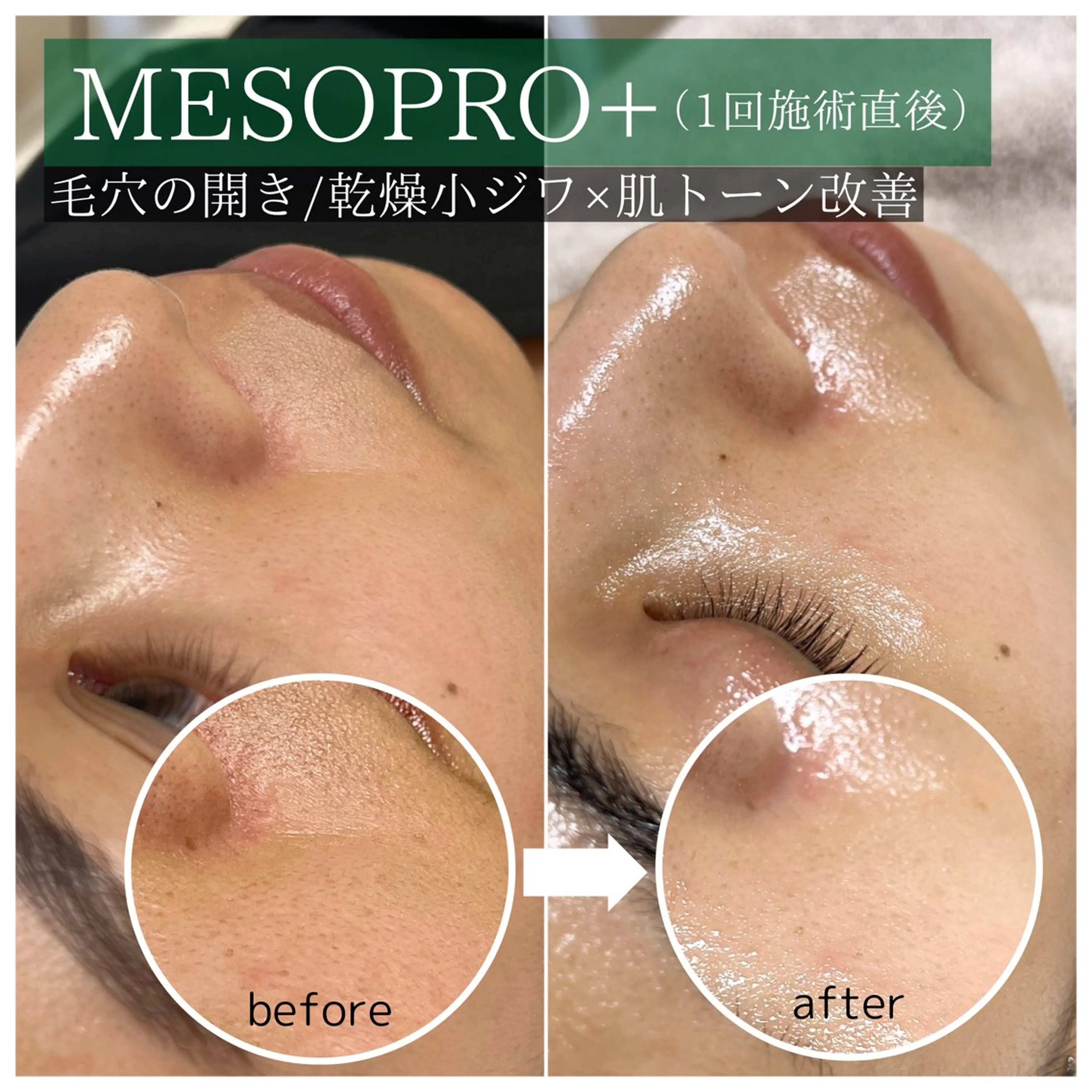 韓国式🇰🇷マイクロニードルエステ🪡MESOPRO（メソプロ）効果👉毛穴の開き/赤み/乾燥小ジワ/くすみ/ゆらぎ肌の写真