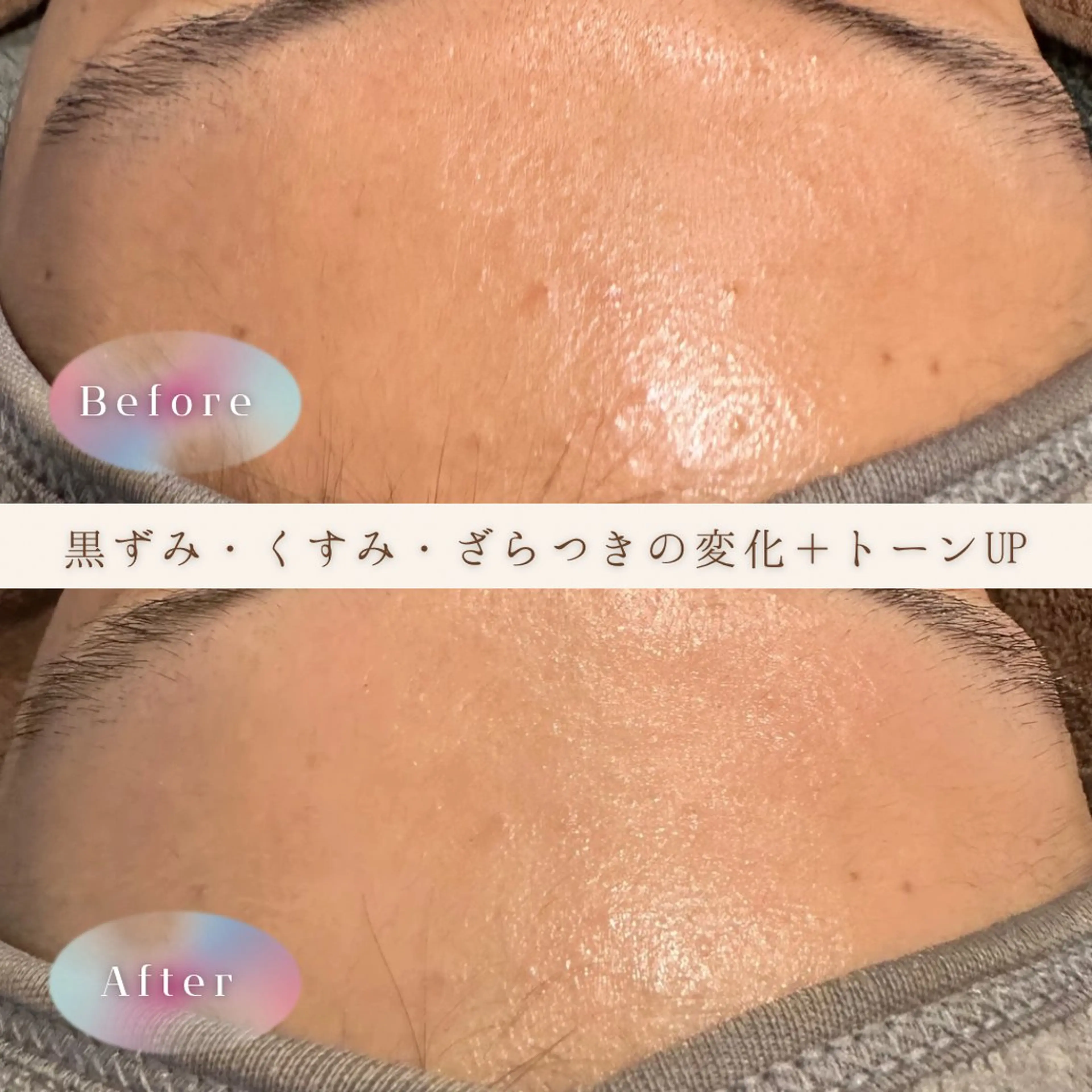 肌改善コース(ヒト幹細胞パック)の写真