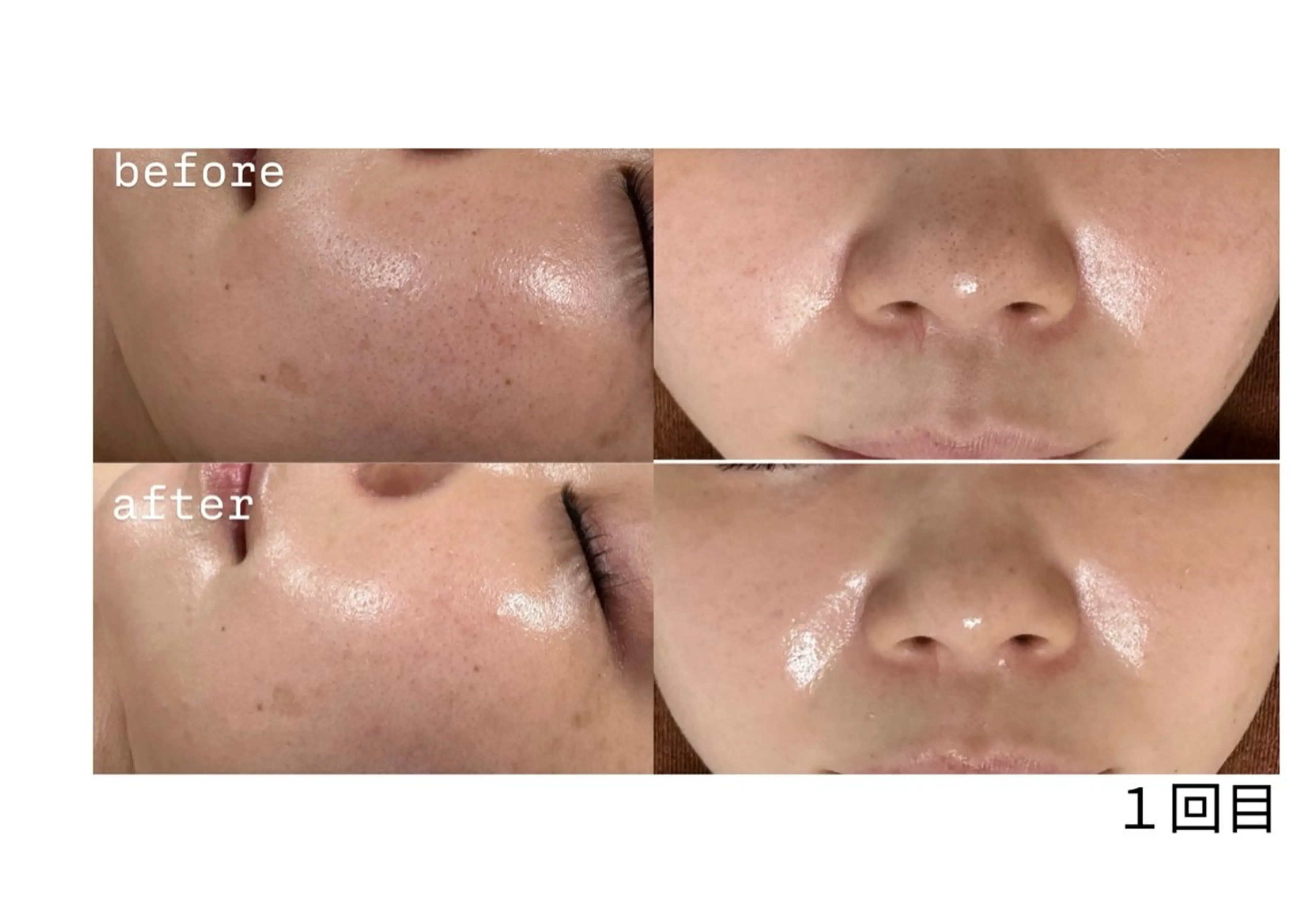 1日垢抜け❣️ハイドラスプラッシュ💦×REVIハーブピーリング🌿の写真