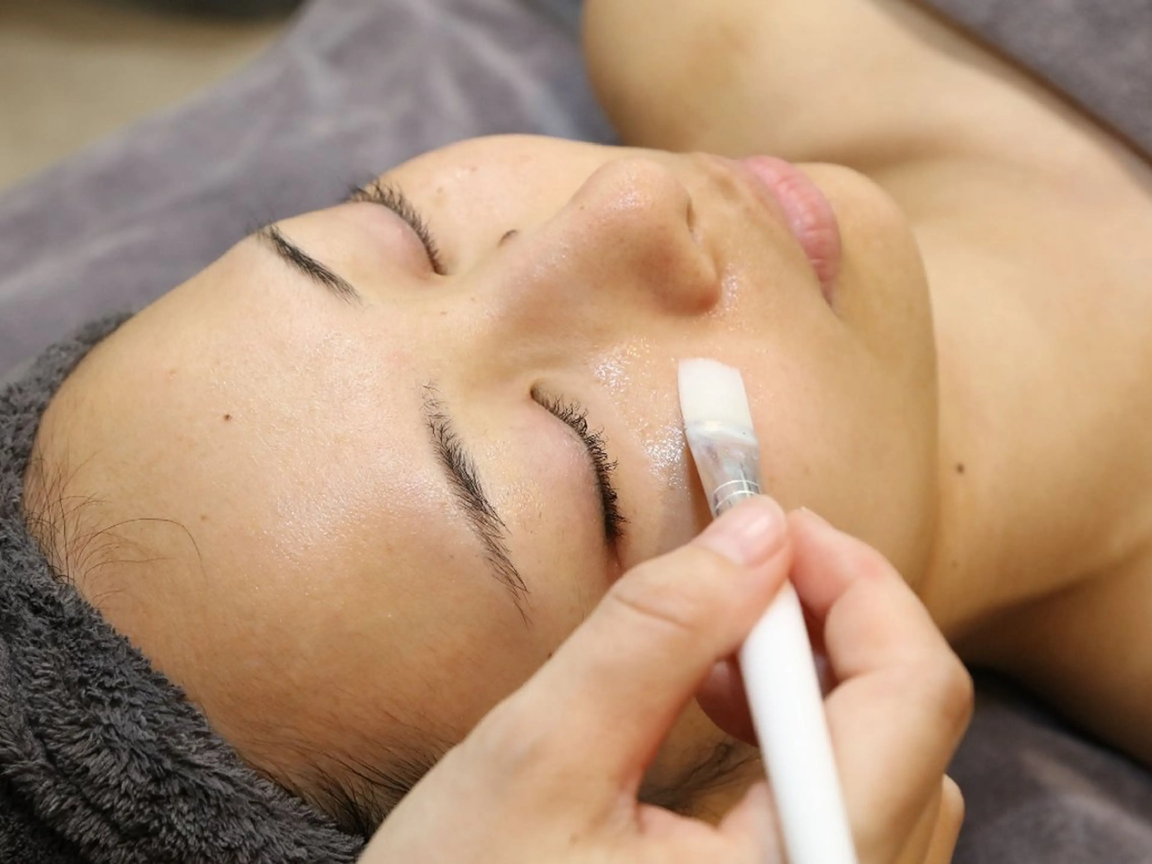 何をしても改善できなかった【ニキビ・ニキビ跡】最強AHAピーリング+高濃度ビタミンC導入50分￥4400の写真