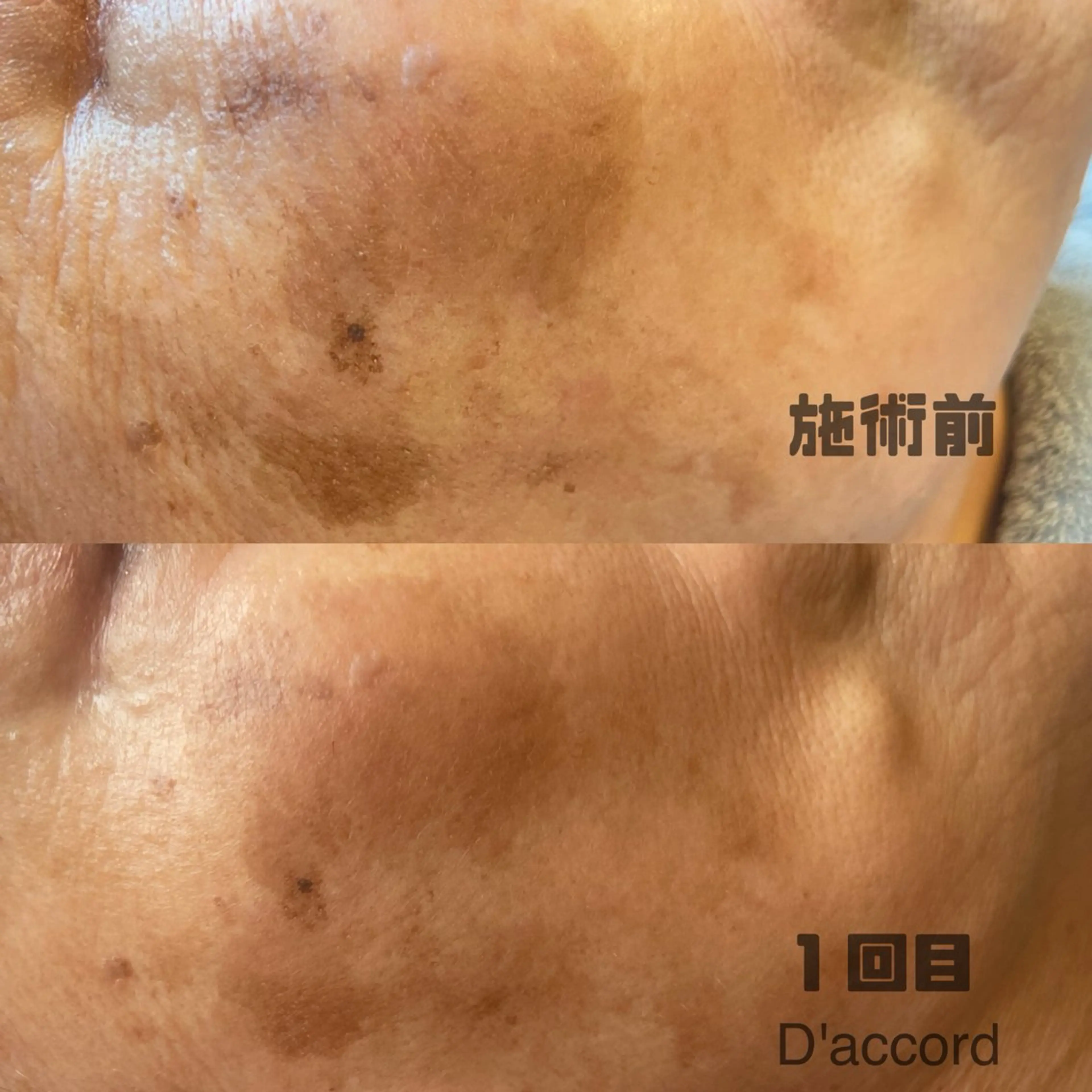 エステ D’accord Rikoのネイルデザイン