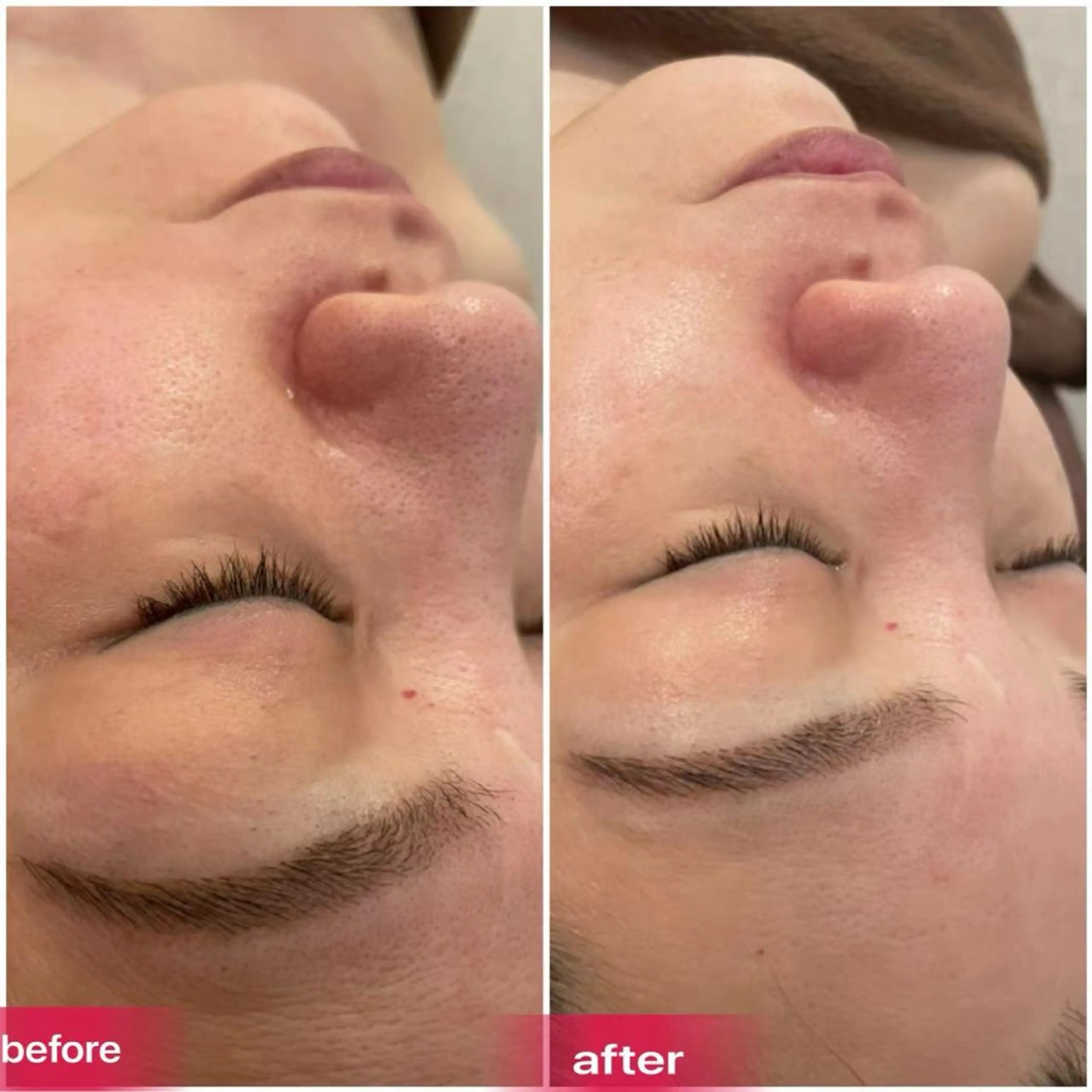 【毛穴＆たるみ改善】美肌×小顔筋膜リリース×小顔ハイパーナイフ　90分の写真