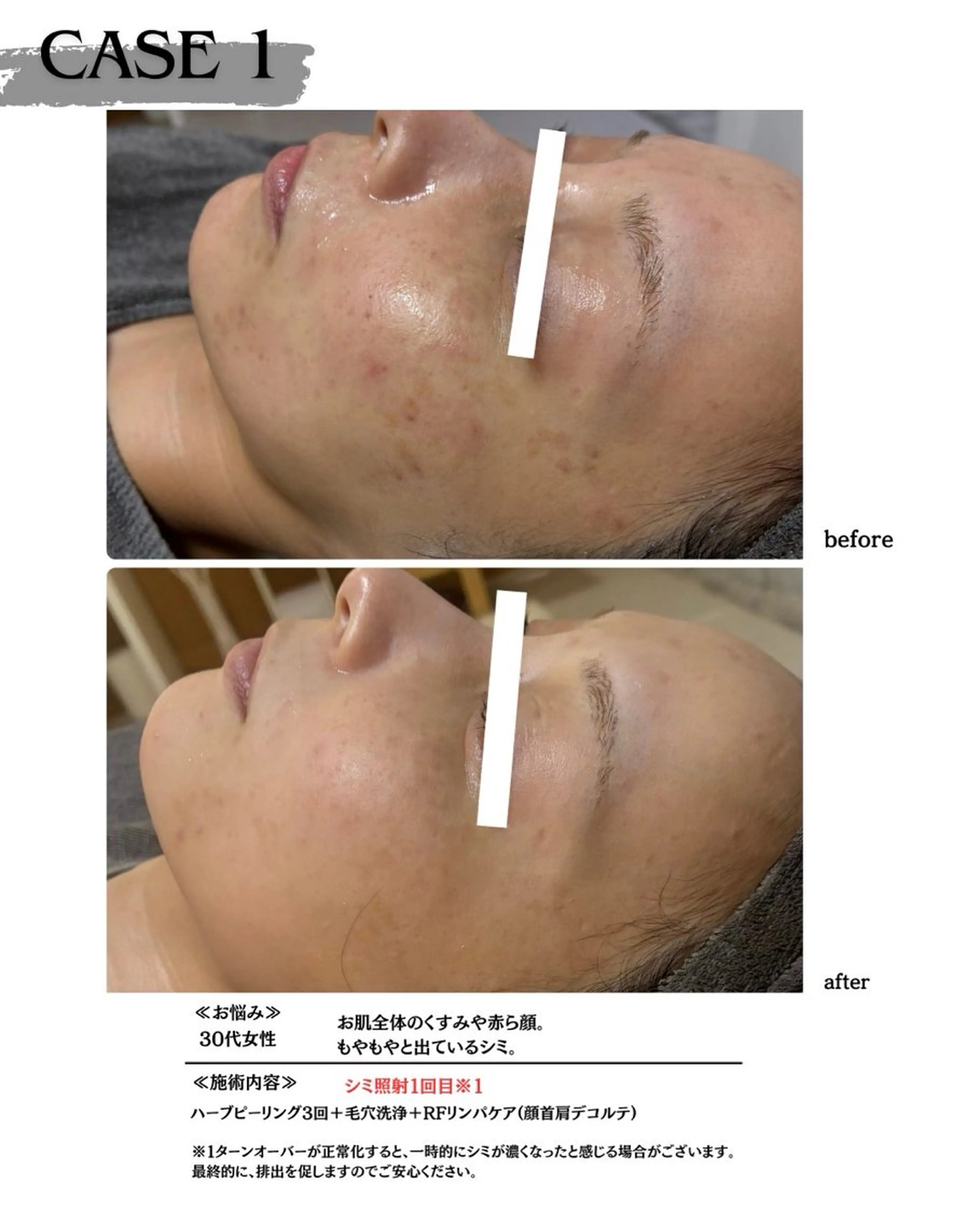 エステ 素肌育成・シミケア専門サロン美潤-miulu-所属・【医療提携サロン】 【シミケア専門】のエステ・リラクイメージ