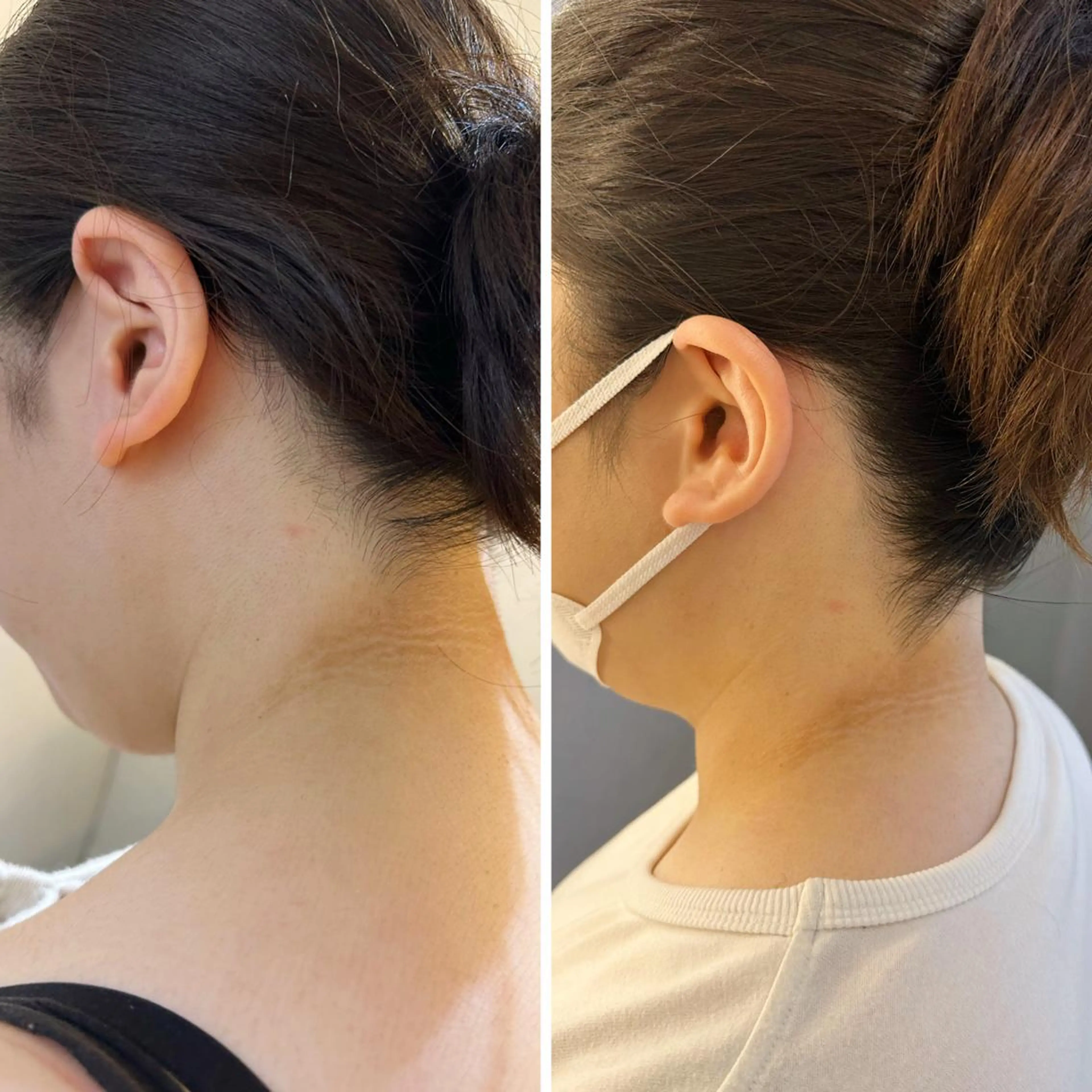 脱毛 うなじ脱毛/美肌脱毛 LABELのエステ・リラクイメージ