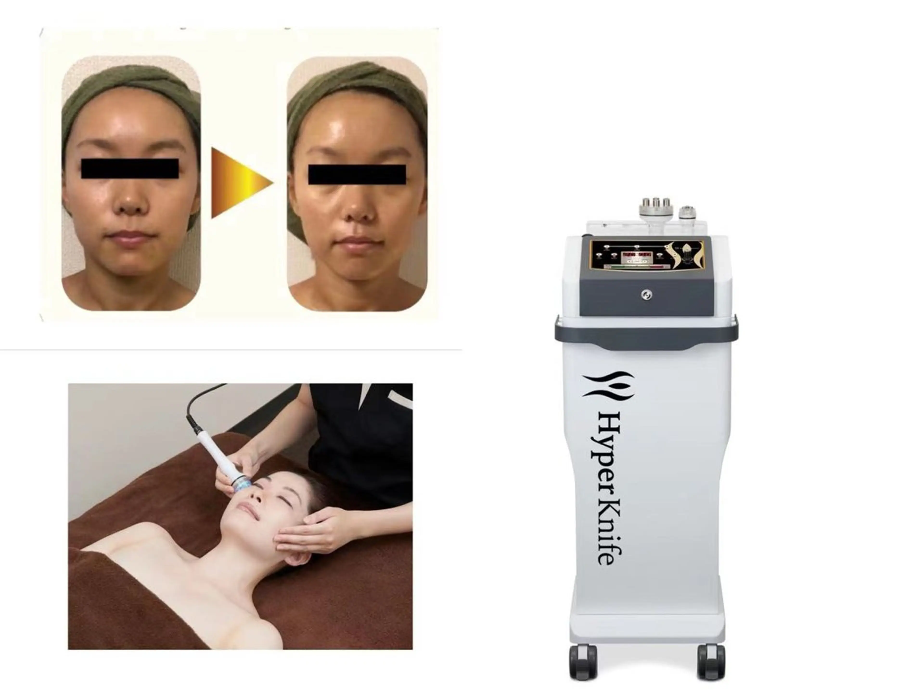 【w機種】むくみスッキリ小顔＆リフトアップ　ハイパーナイフ＆シェイプ90分の写真