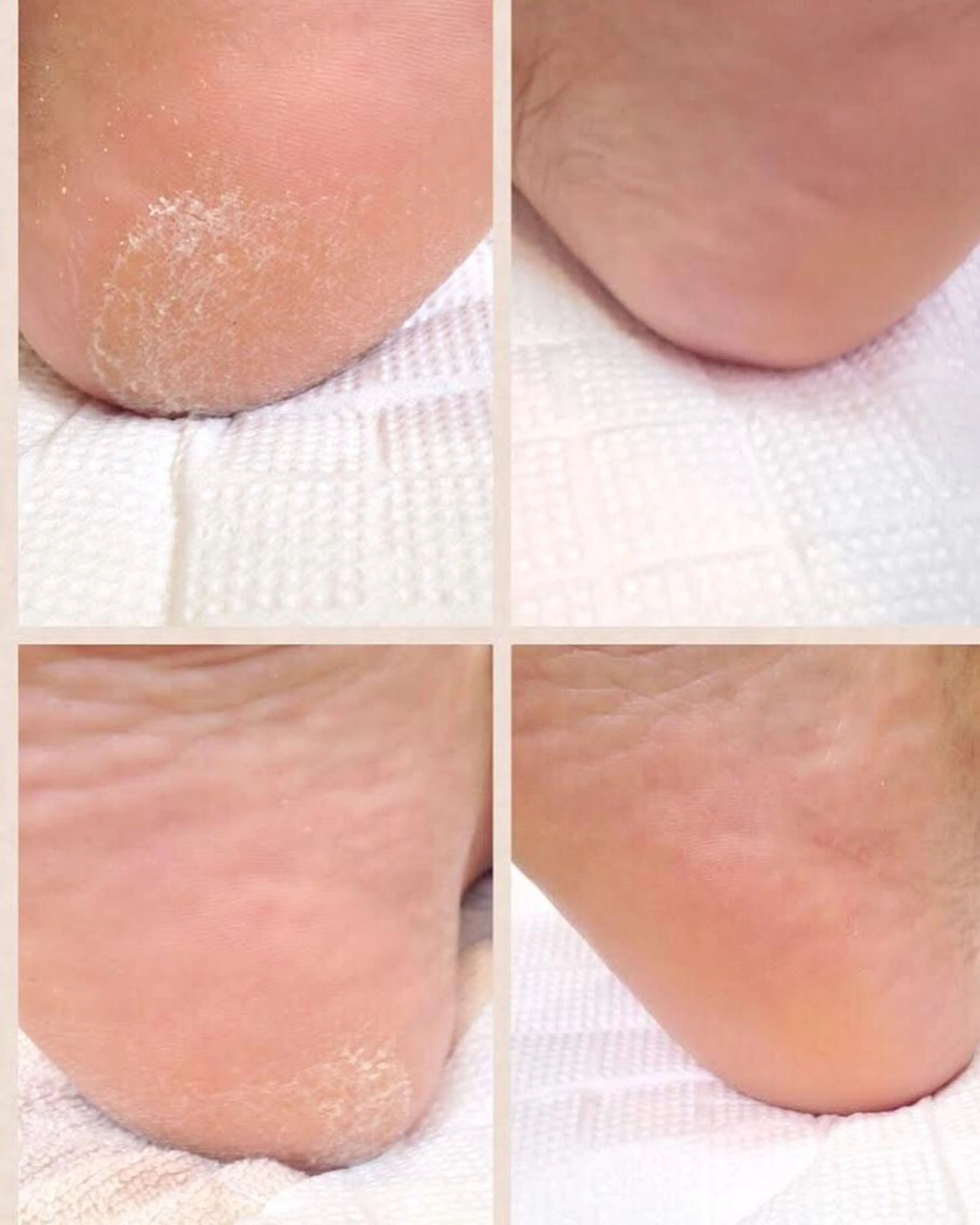 【踵の角質除去】ふわふわの足裏に♪の写真