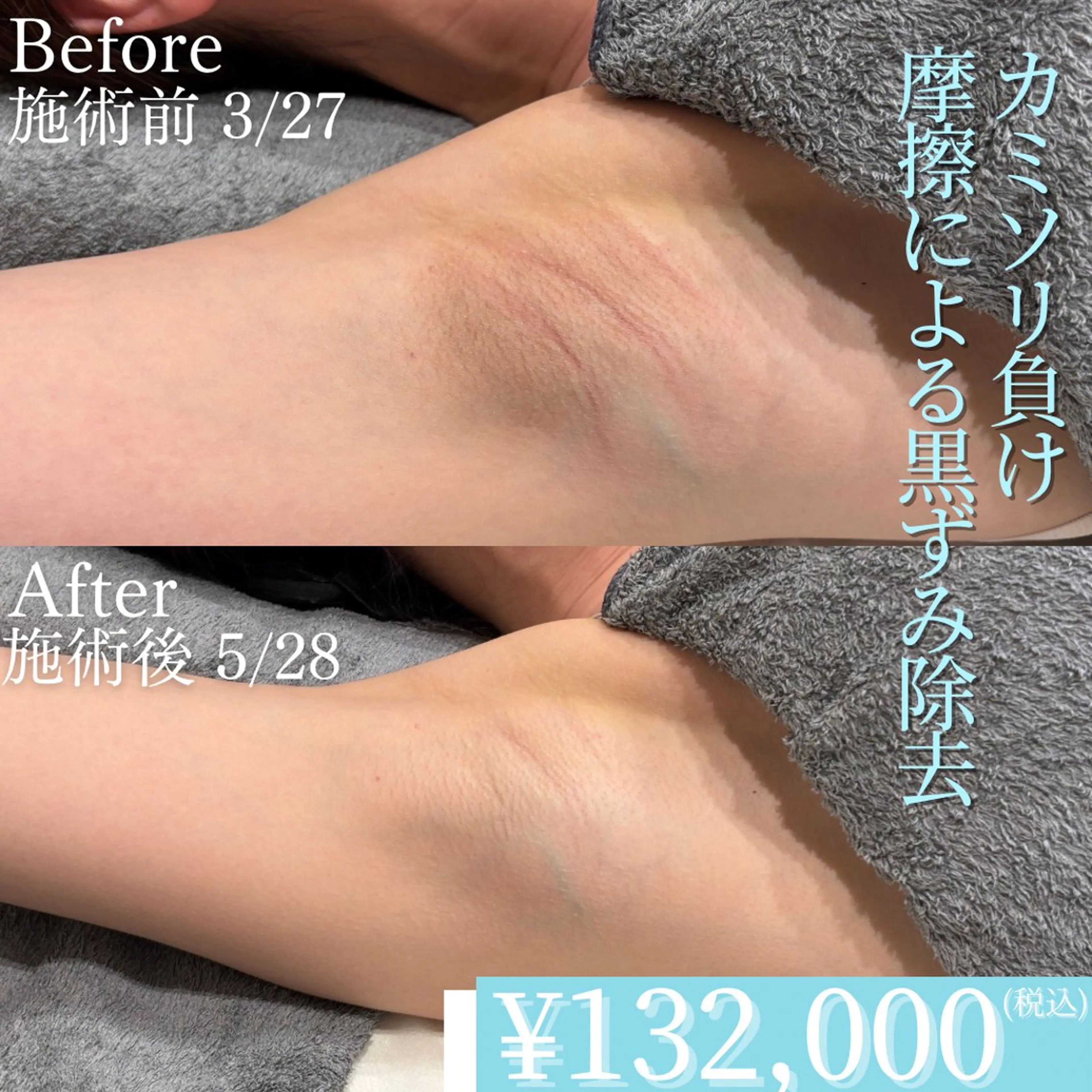 色素沈着・メラニン除去🫧ローマピンク40%OFF【両脇】アフタークリーム3本プレゼント🎁実質60%OFF相当！の写真